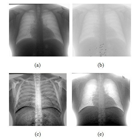 Motion correction system for dual-energy subtraction chest X-ray image