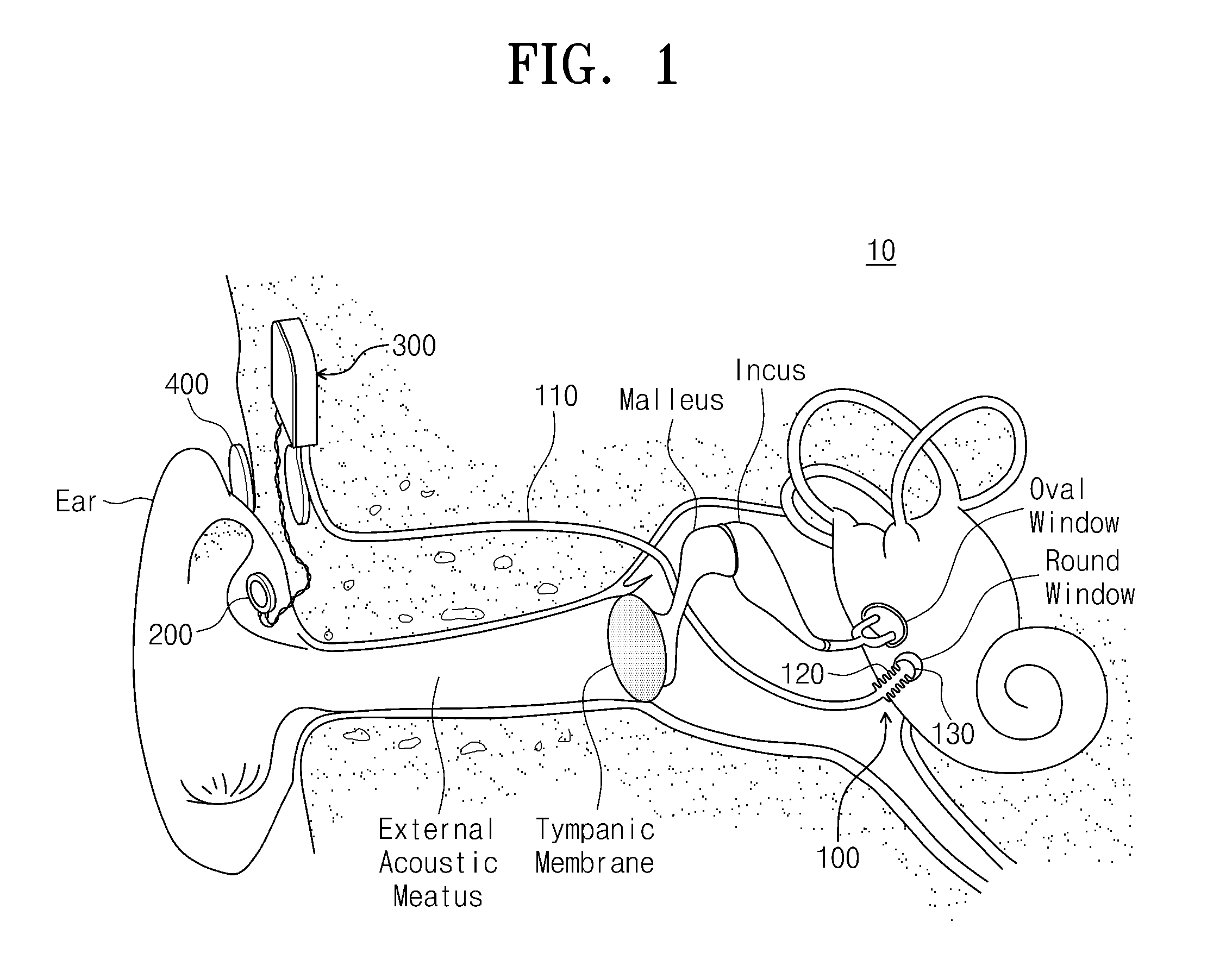 Vibration transducer and implantable hearing aid device