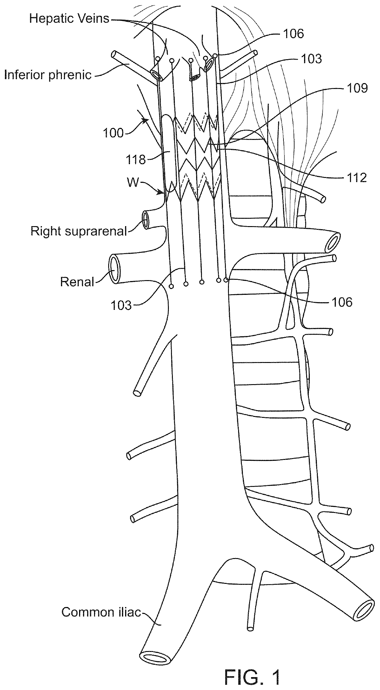 Implantable devices and related methods for heart failure monitoring