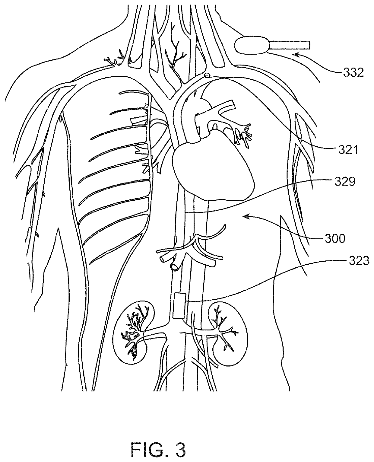 Implantable devices and related methods for heart failure monitoring