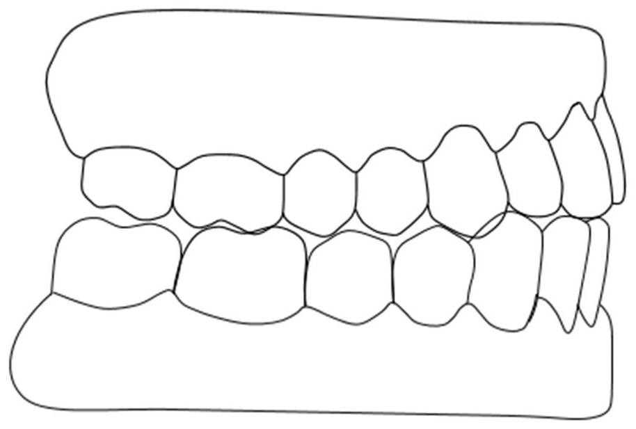 A method for preparing an appliance for abnormal repositioning of the mandible