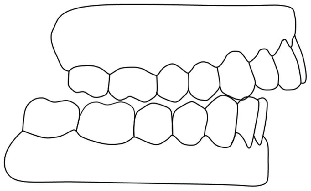 A method for preparing an appliance for abnormal repositioning of the mandible