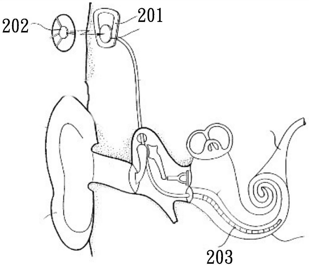 External electronic ear device and artificial ear implant device