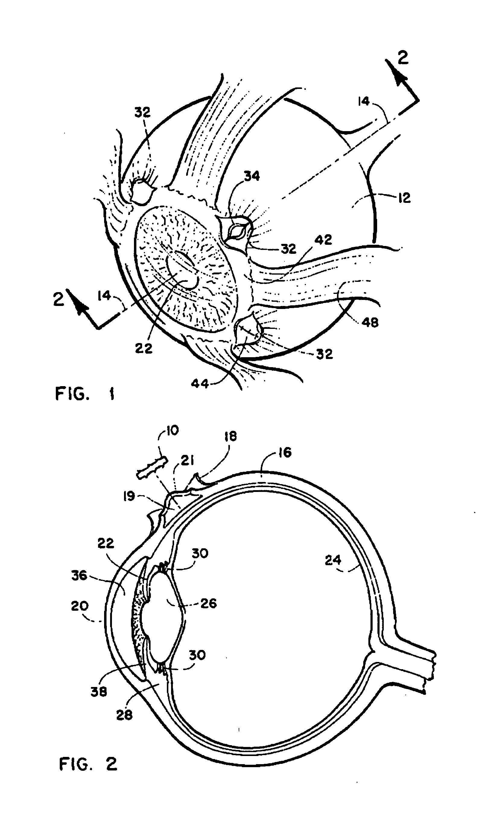Method and intra-sclera implant for treatment of glaucoma and presbyopia