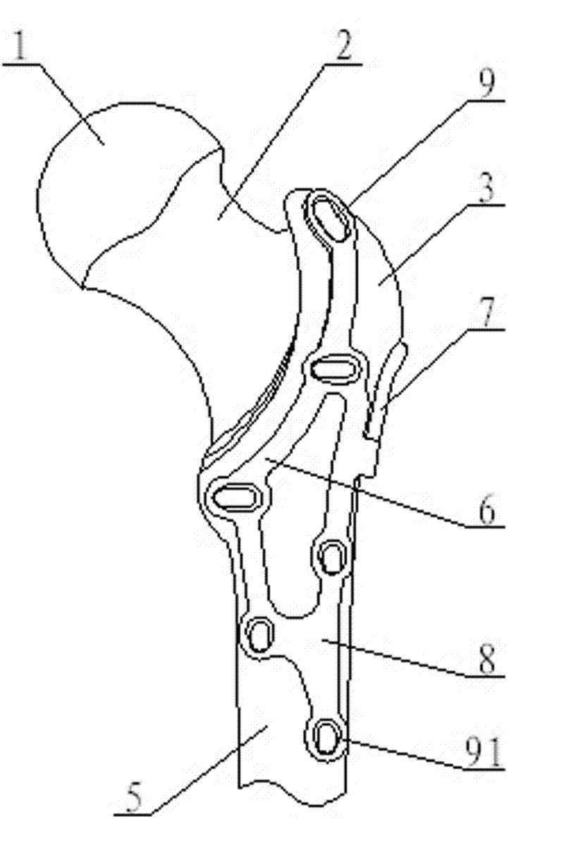 Minimal invasive combined pressurizing and locking bone fracture plate for trochanter comminuted fracture and femoral neck fracture