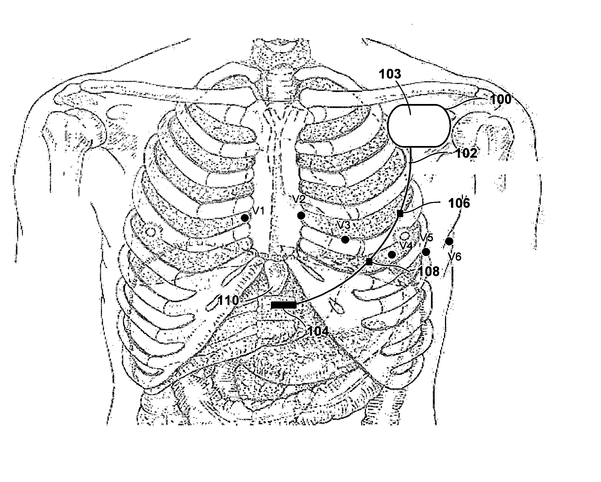 Subcutaneous defibrillation system and method using same