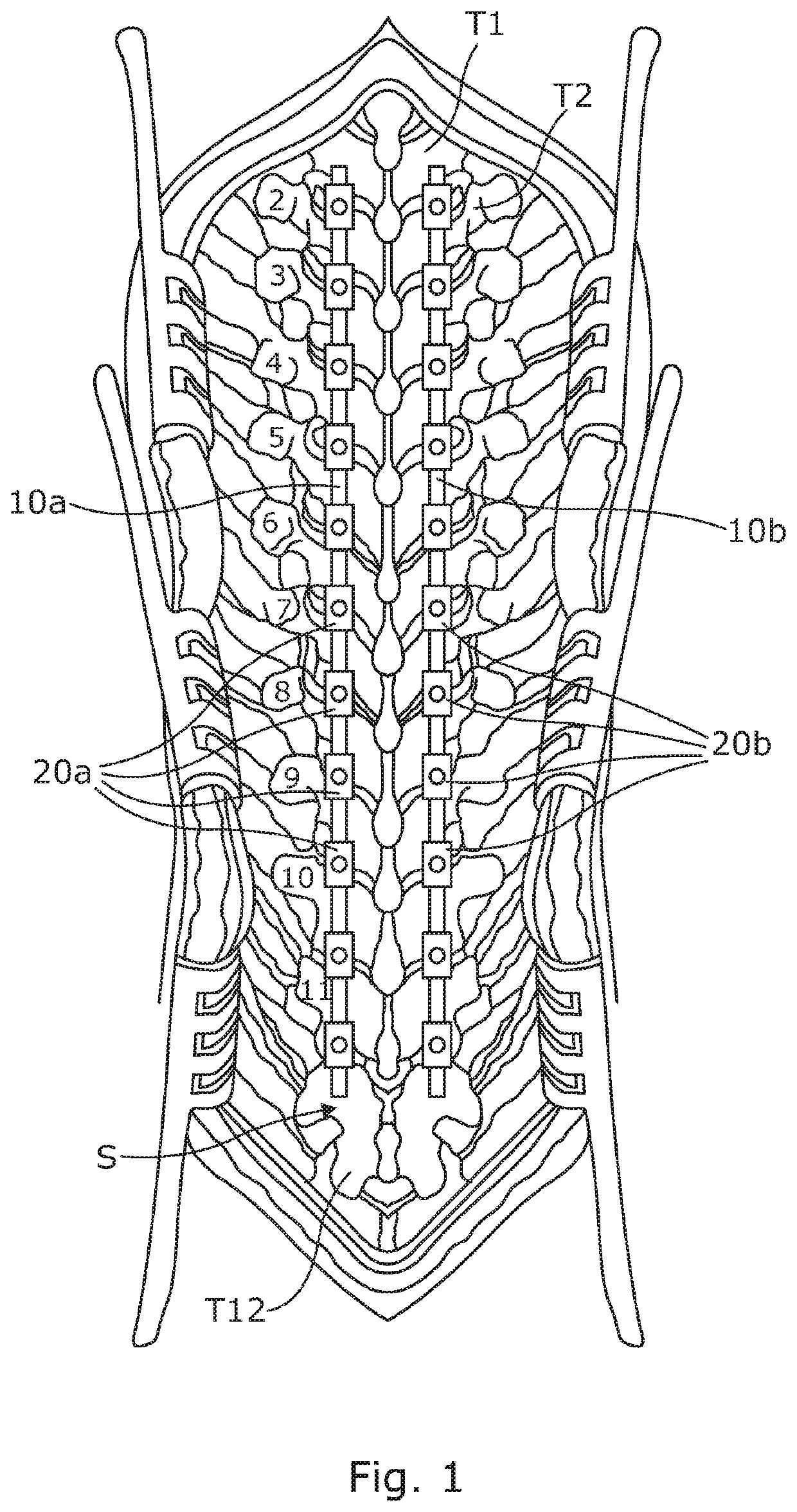 Anchoring device for use in spinal deformity correction surgery