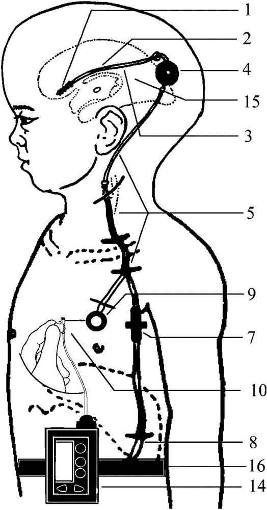 Cerebrospinal fluid circulation assisting apparatus