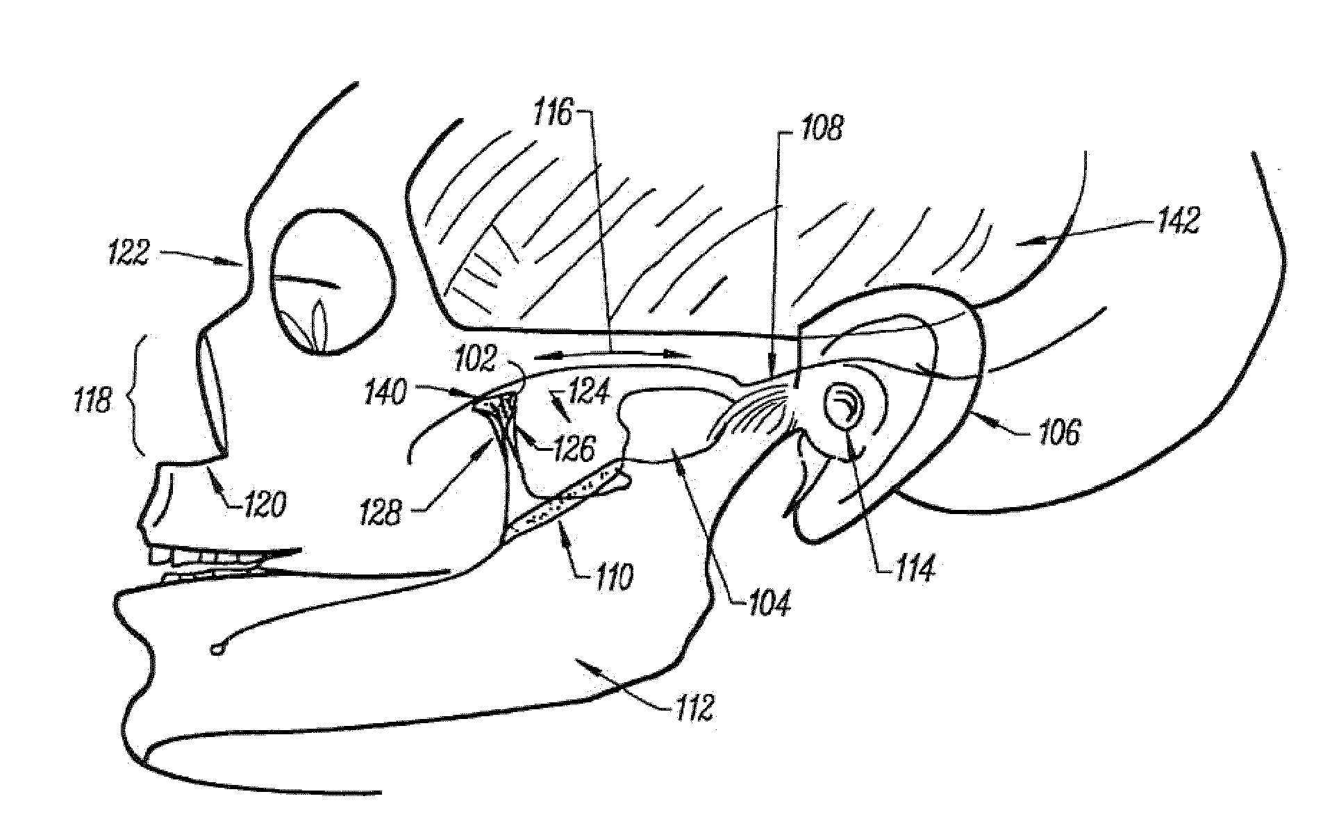 Stimulation method for the sphenopalatine ganglia, sphenopalatine nerve, or vidian nerve for treatment of medical conditions