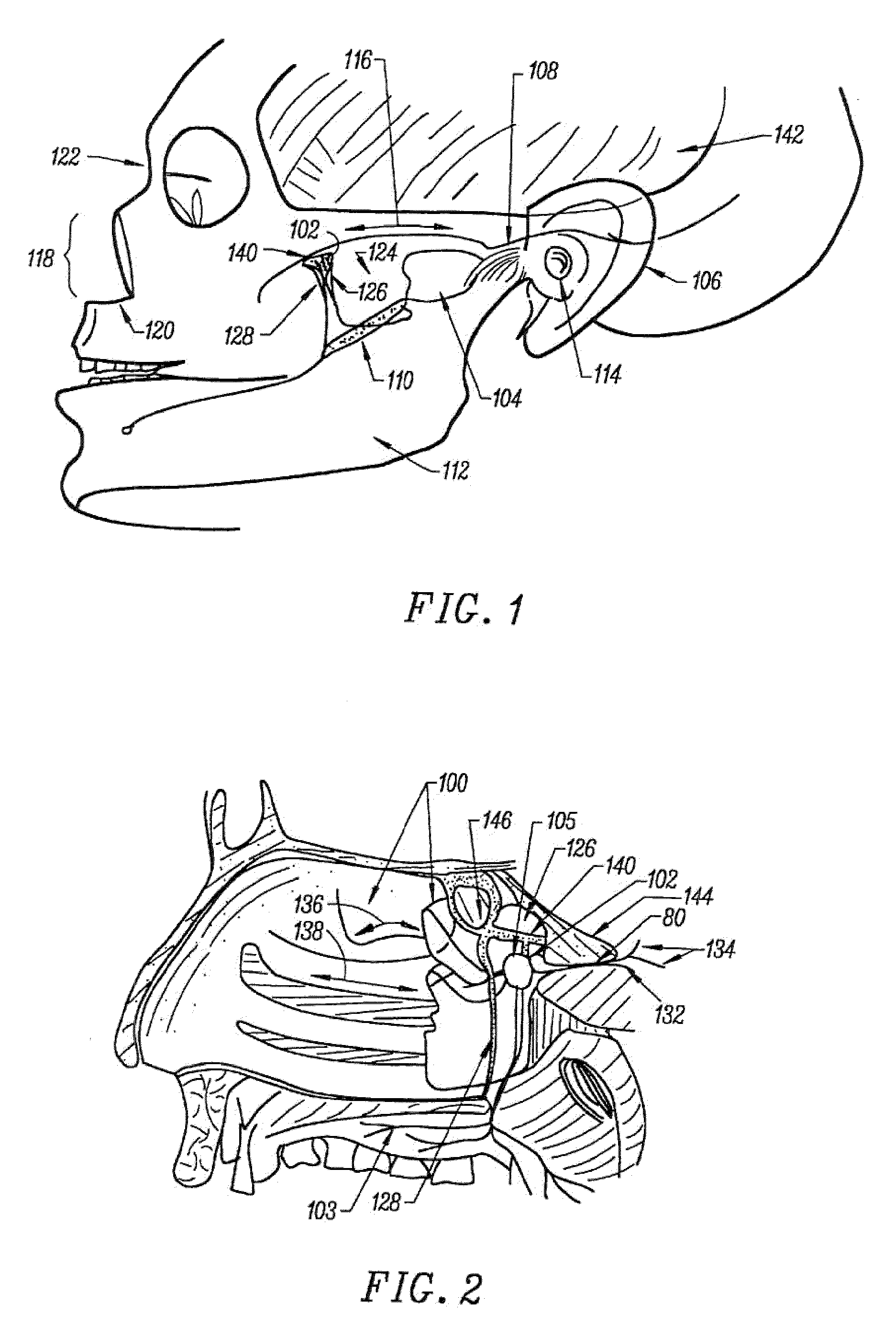 Stimulation method for the sphenopalatine ganglia, sphenopalatine nerve, or vidian nerve for treatment of medical conditions