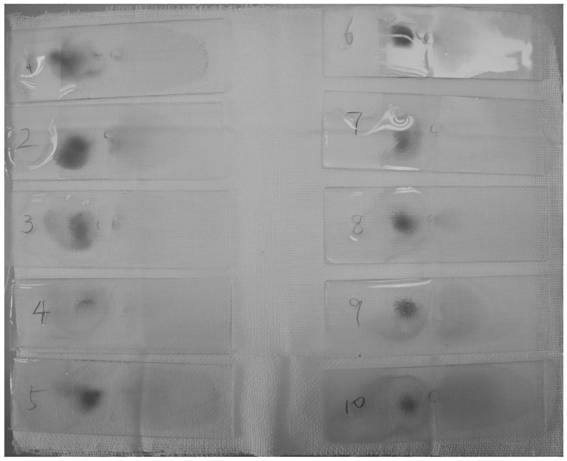 Treatment method of thick blood film of blood smear for plasmodium microscopic examination