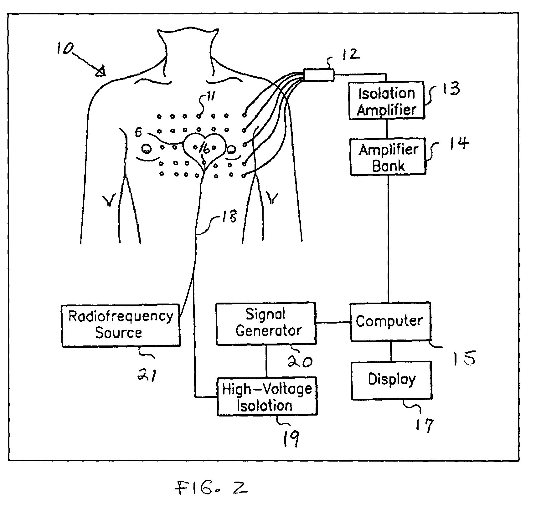 Method and apparatus for the guided ablative therapy of fast ventricular arrhythmia