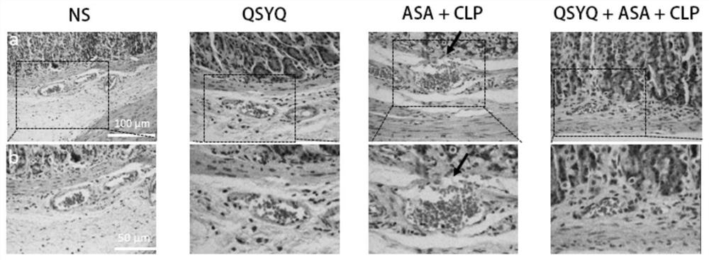 Application of traditional Chinese medicine astragalus membranaceus and radix salviae miltiorrhizae qi-tonifying preparation in treatment of gastrorrhagia