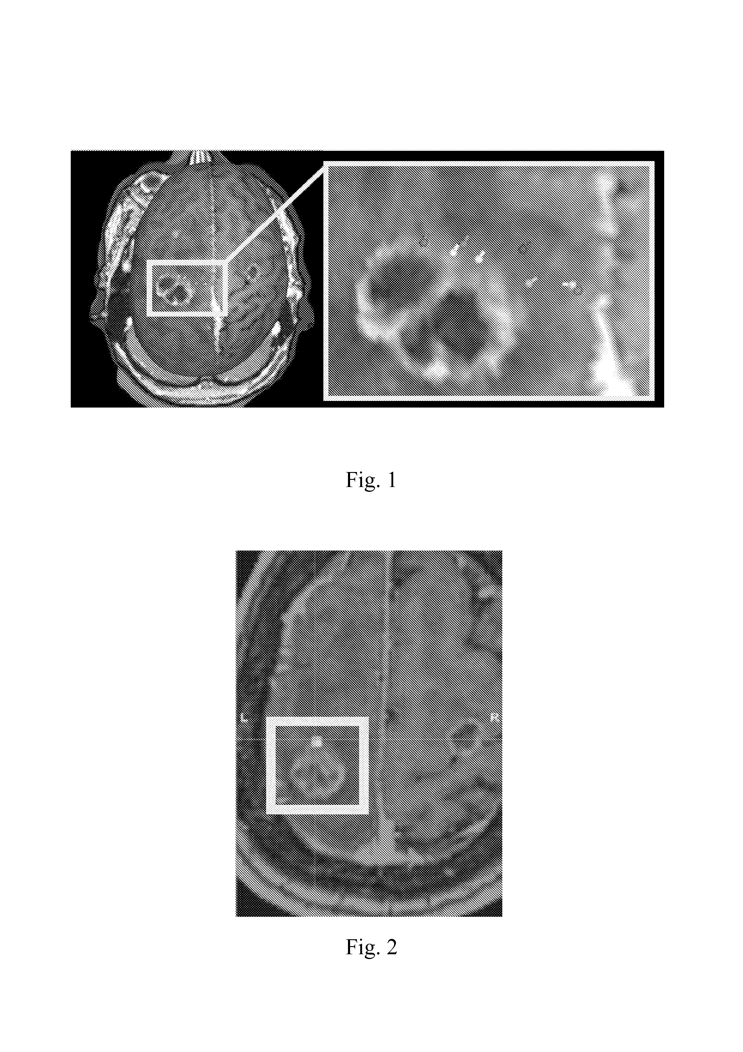 Method and system for combining anatomical connectivity patterns and navigated brain stimulation
