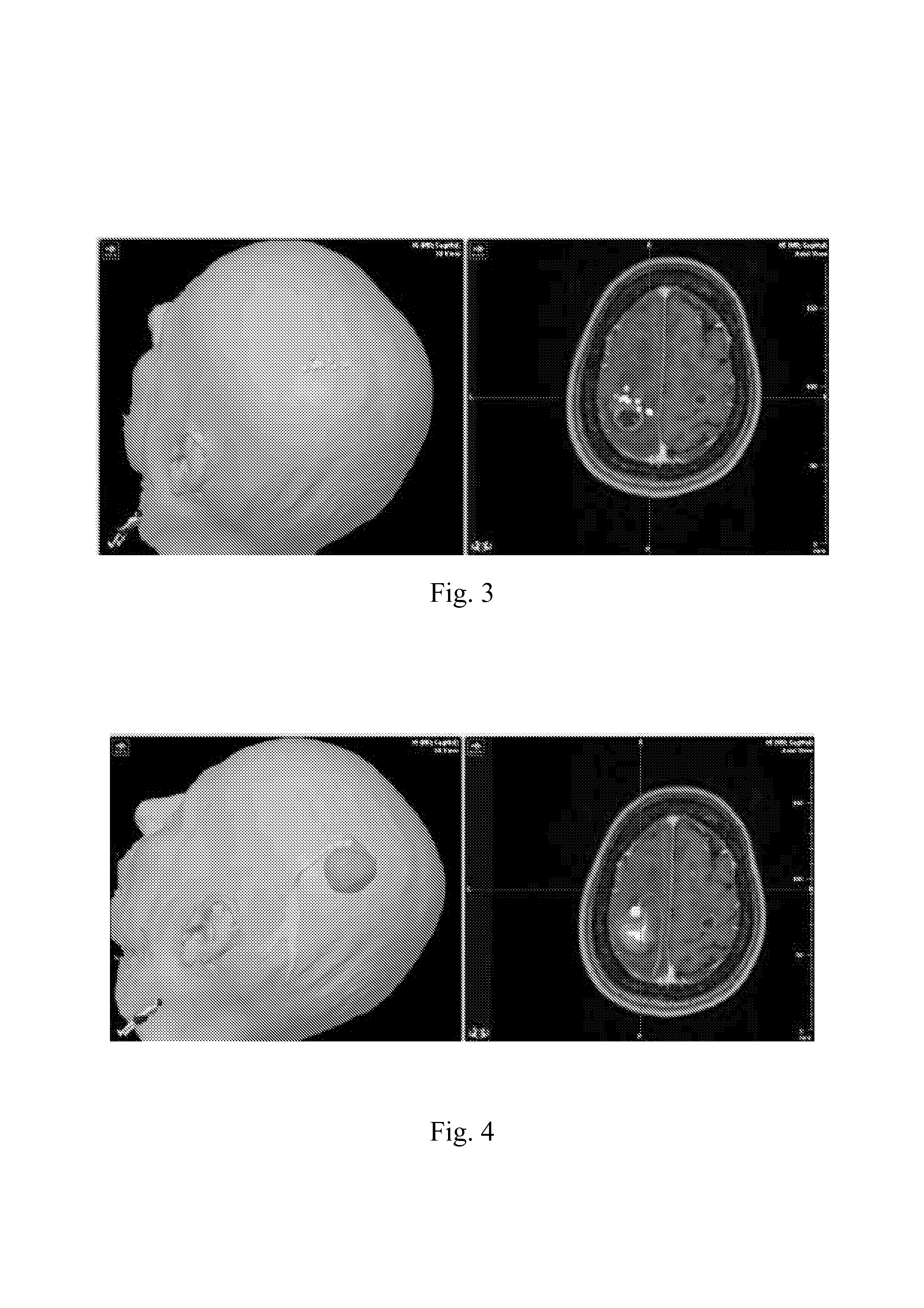 Method and system for combining anatomical connectivity patterns and navigated brain stimulation