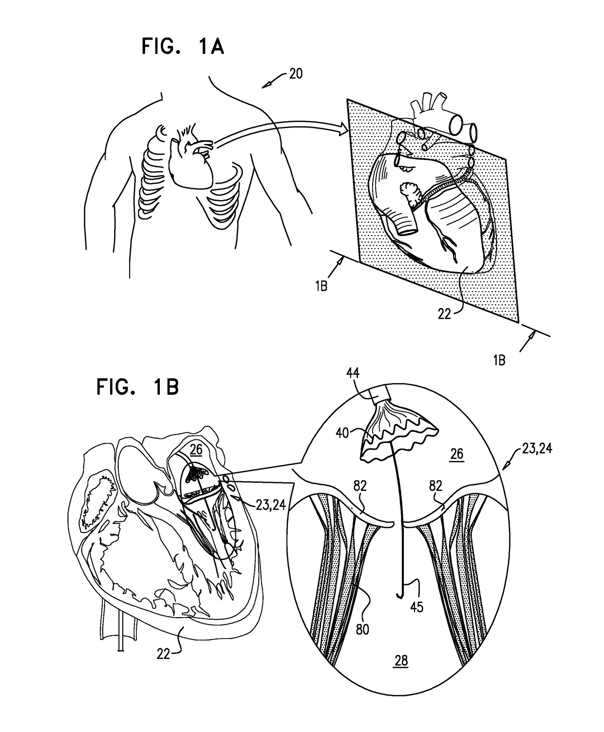 Techniques for percutaneous mitral valve replacement and sealing