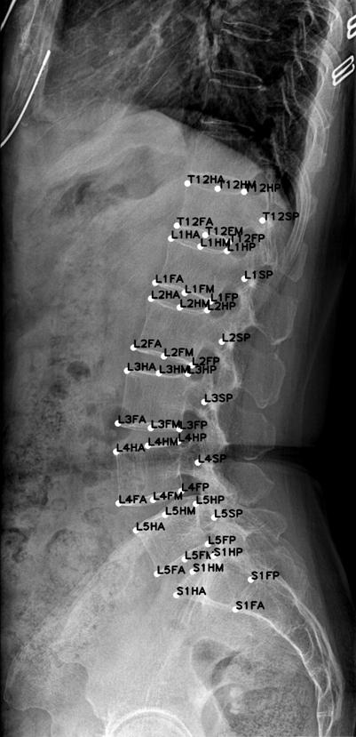 Semi-supervised cyclic self-learning method for few lumbar vertebra medical image samples and model