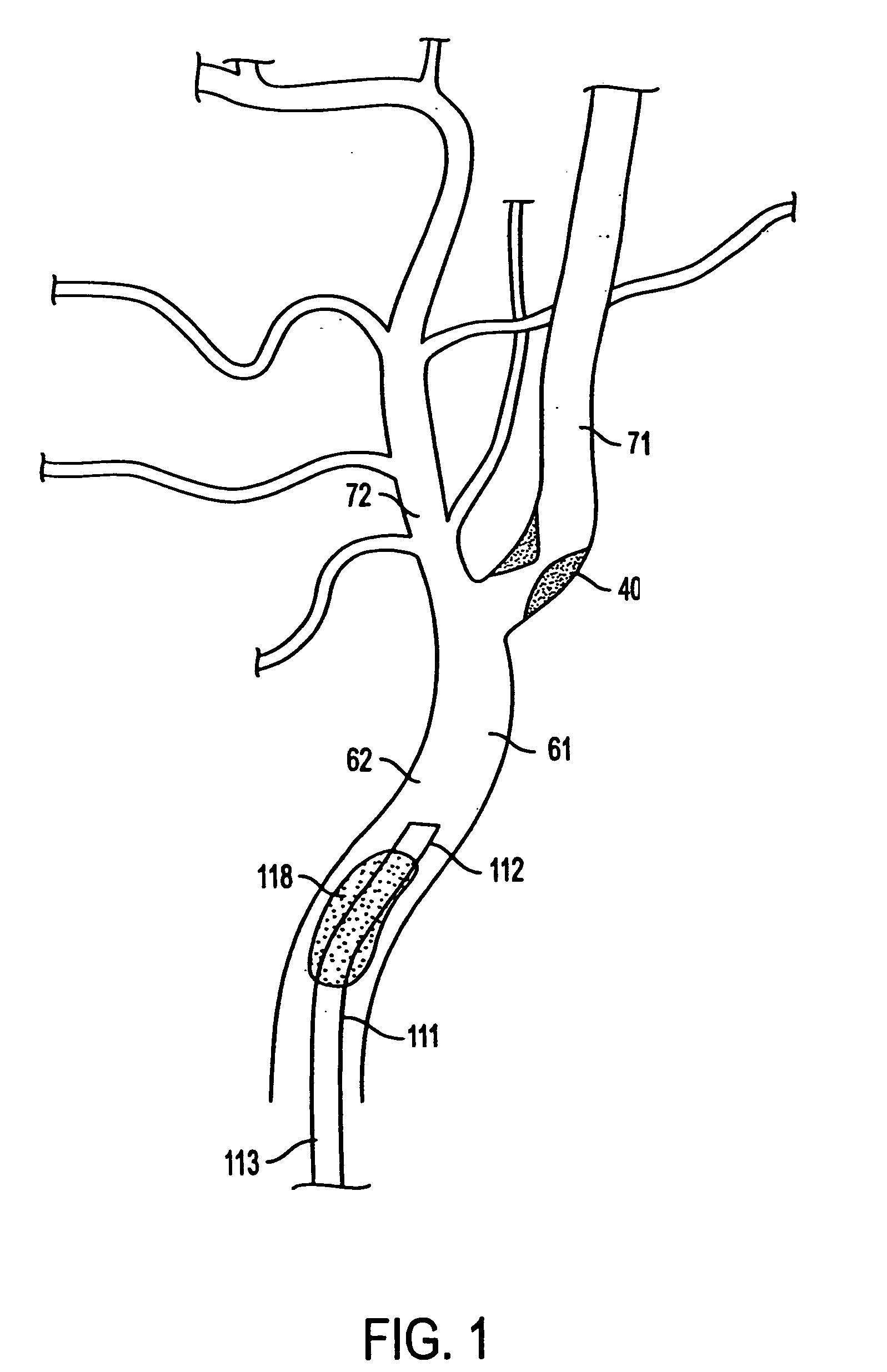 ICA angioplasty with cerebral protection