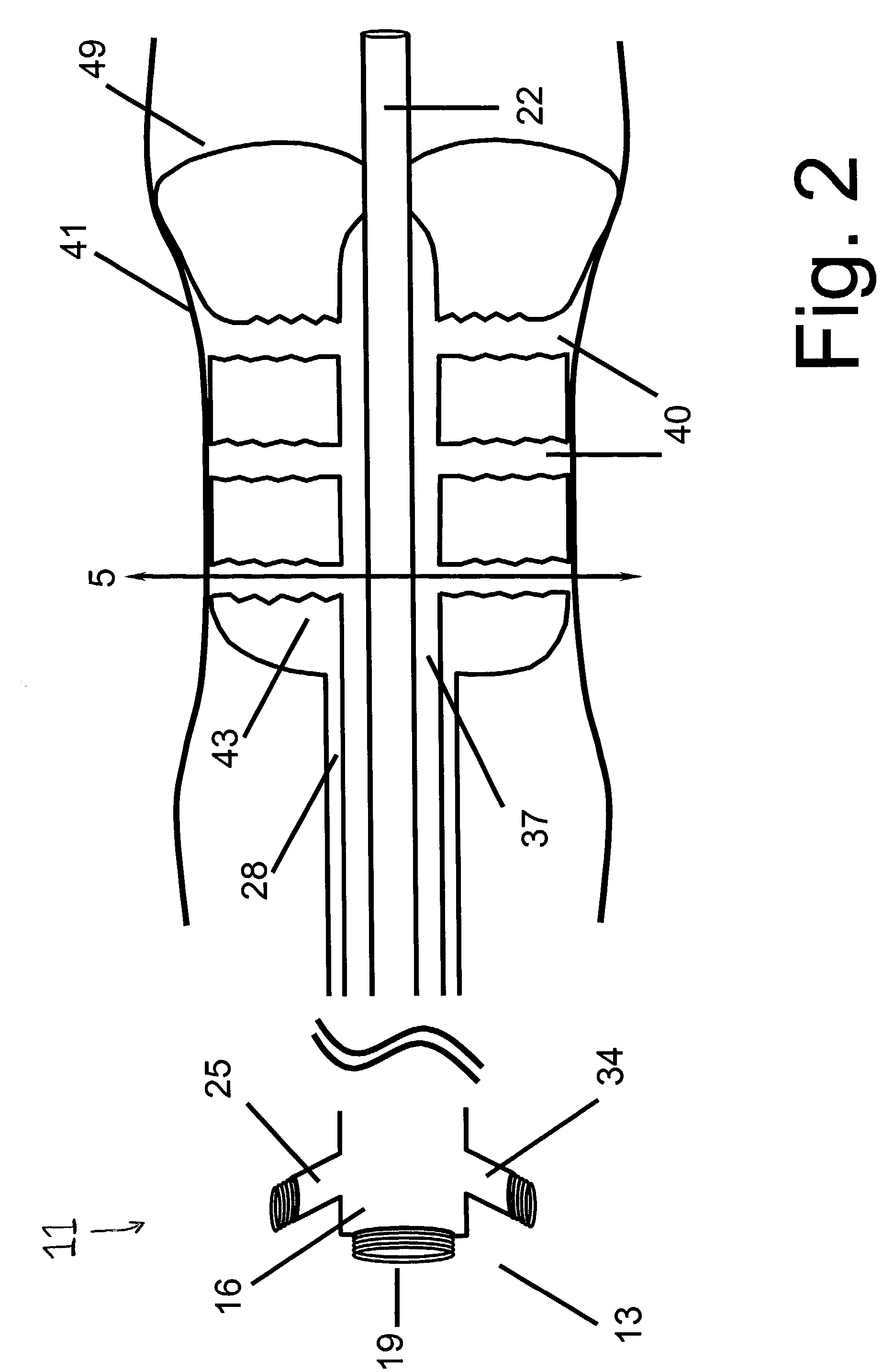 Angioplasty device with embolic recapture mechanism for treatment of occlusive vascular diseases