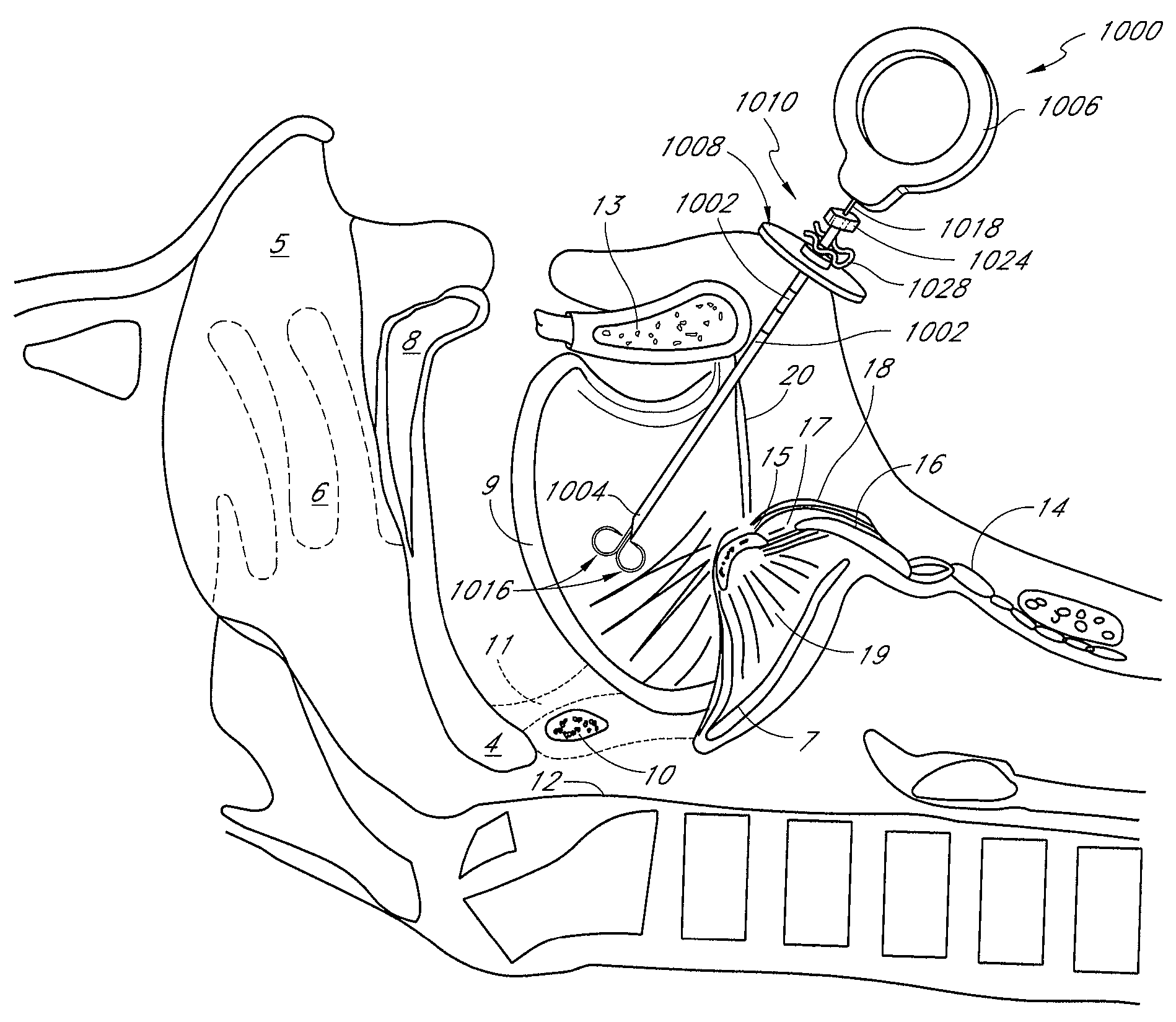 System and method for temporary tongue suspension