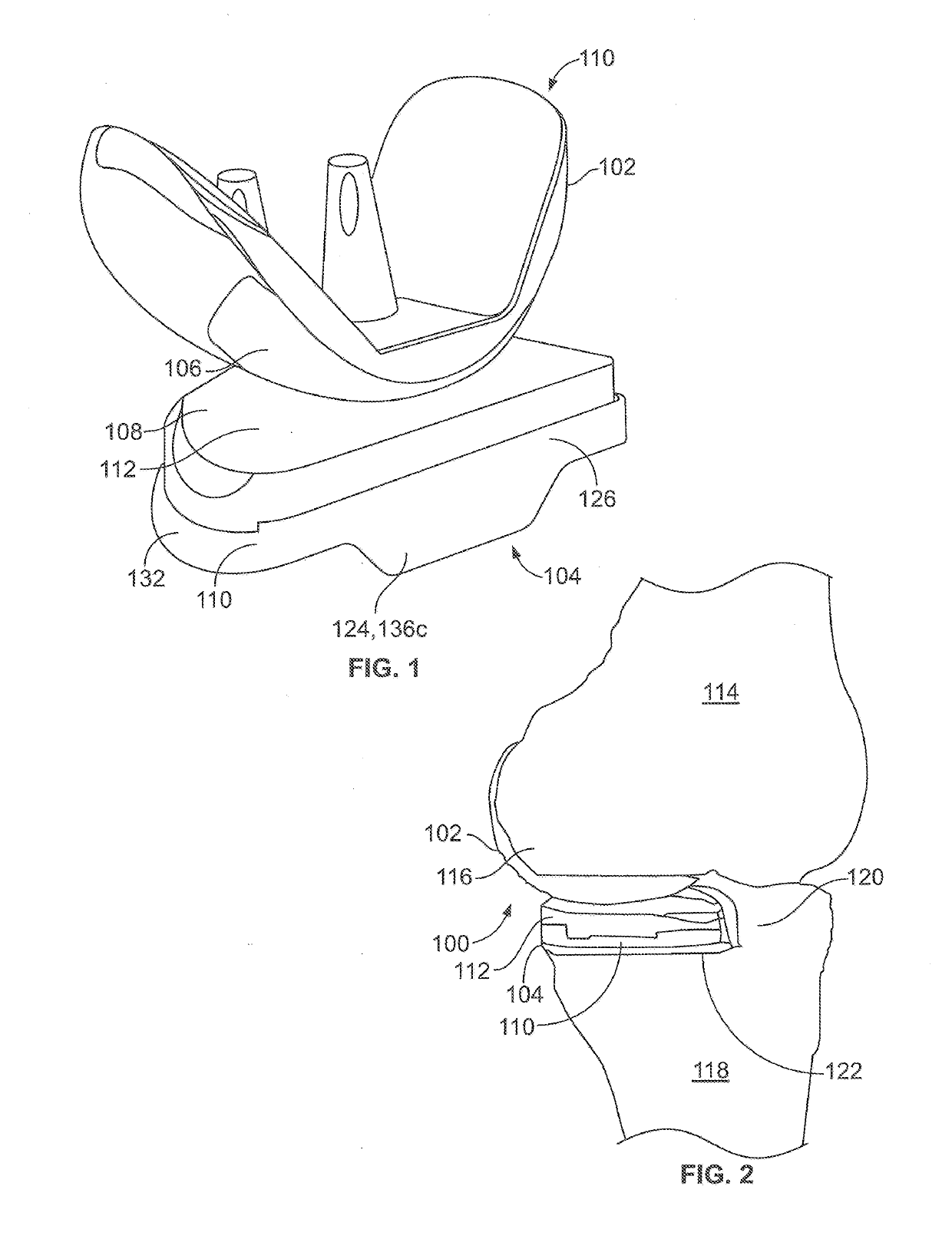 Unicondylar tibia implants