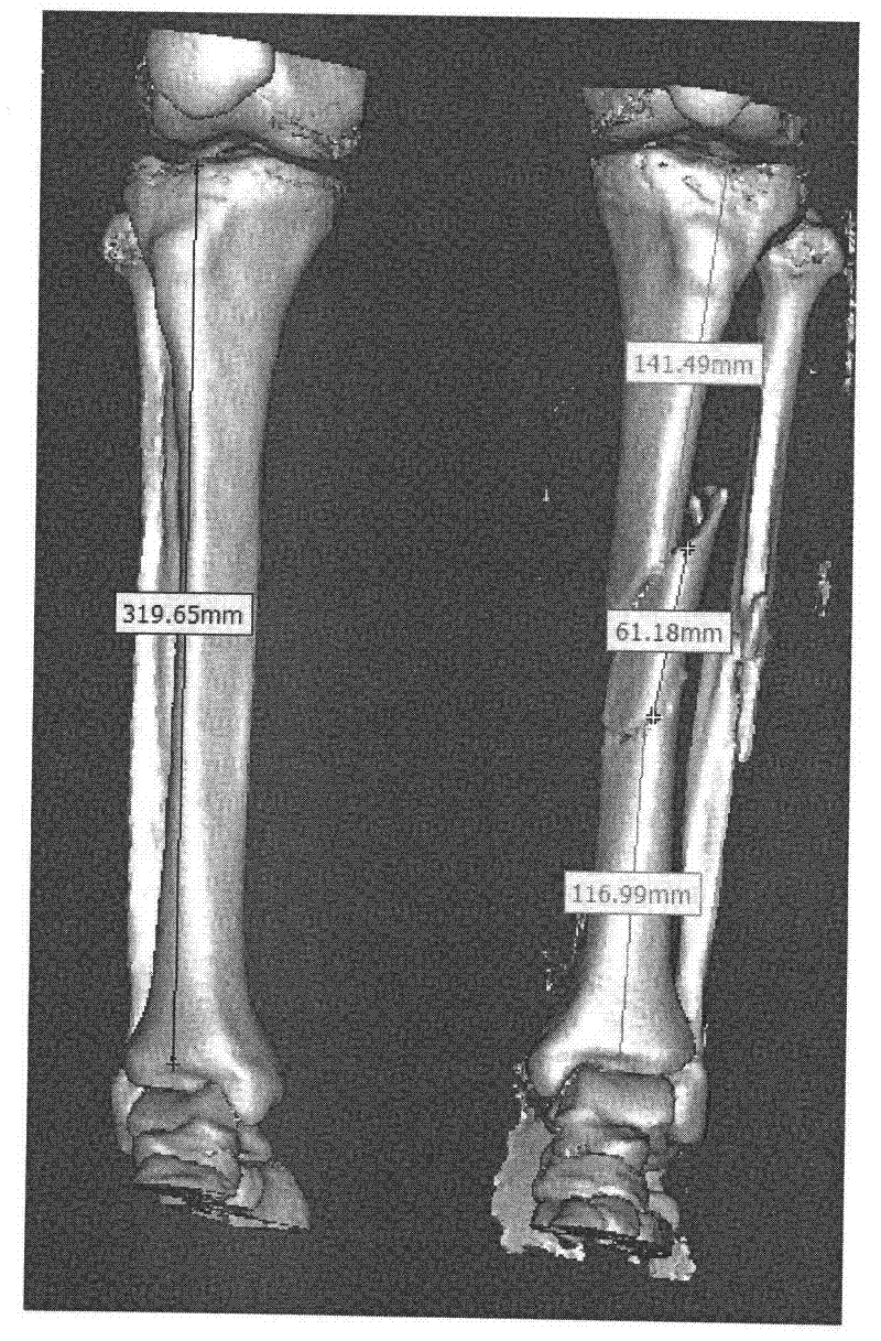 Internal fixation therapeutic method of tibial fracture