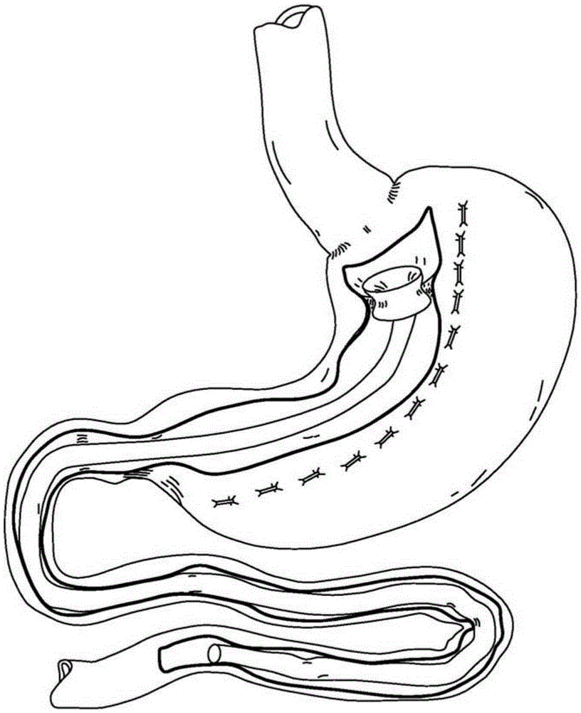 Intraluminal Esophageal Restriction Devices