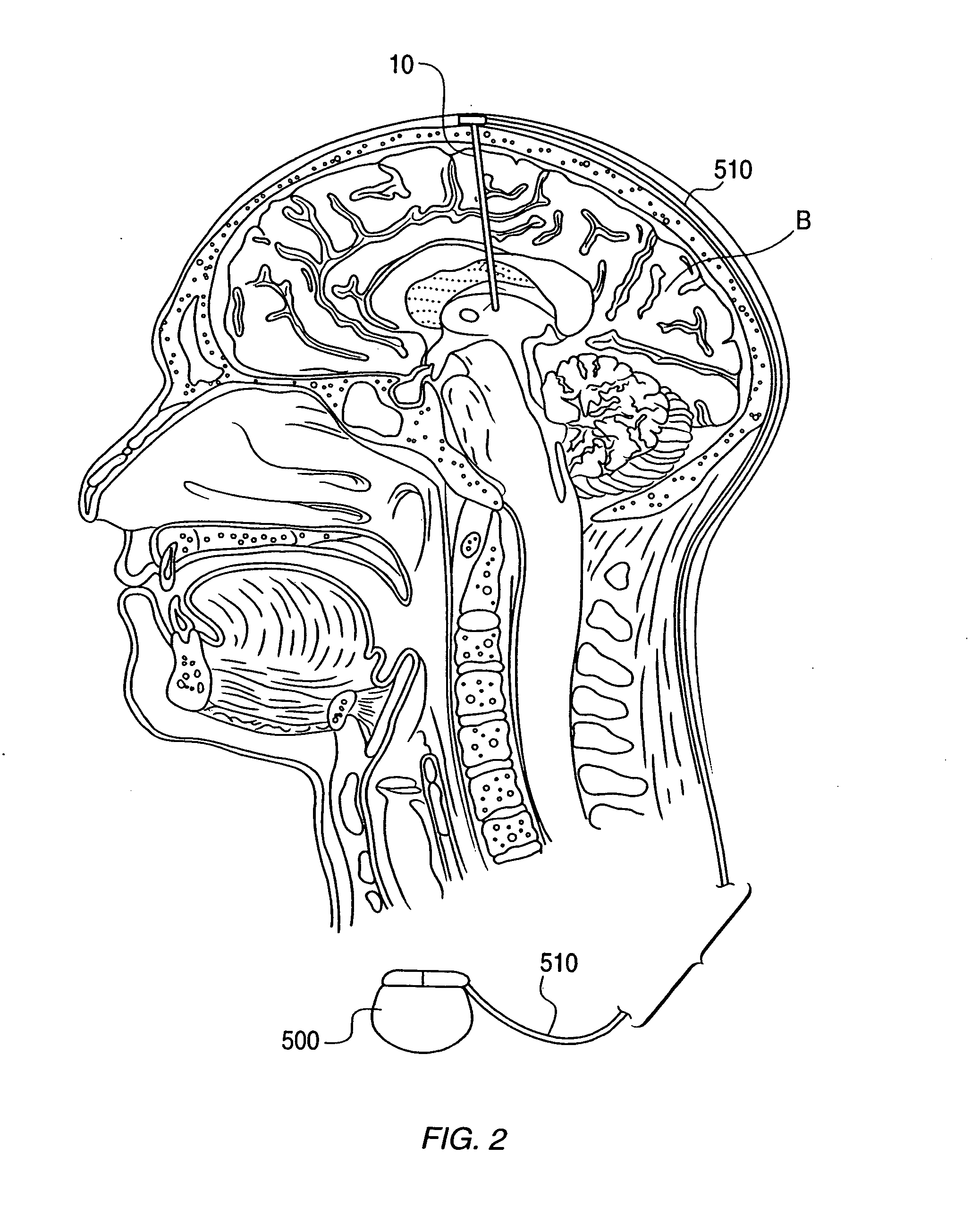 Neural stimulation delivery device with independently moveable delivery structures
