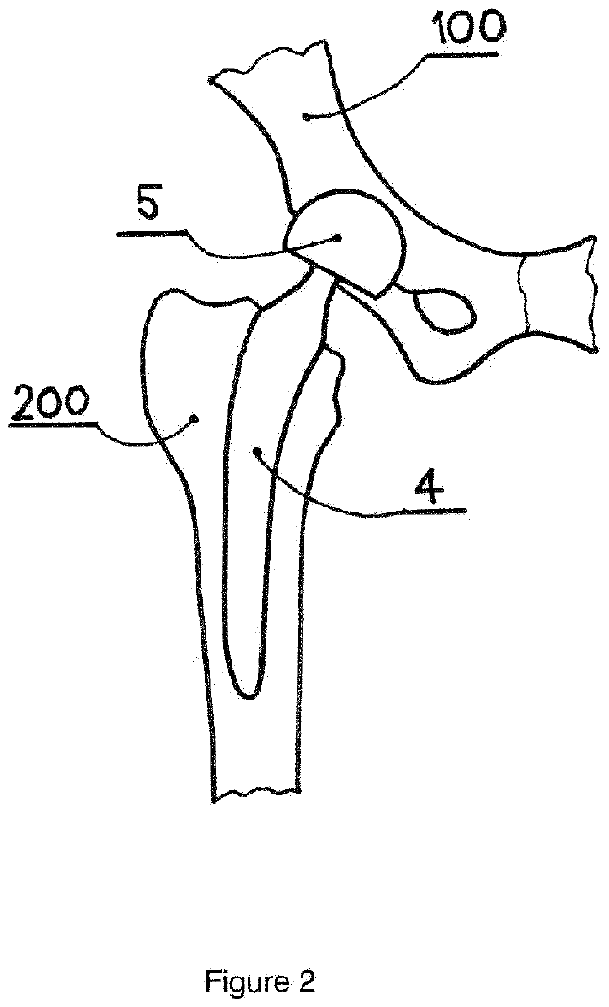 Resurfacing  cup for acetabulum hemiarthroplasty of the hip joint