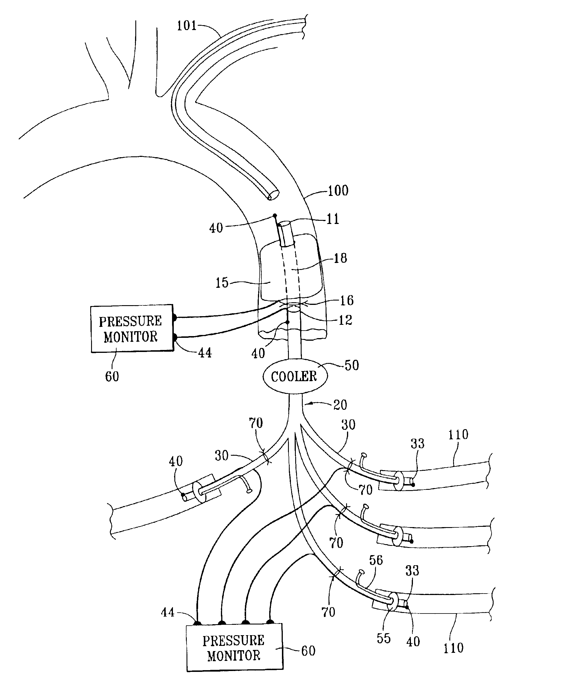 Aortic shunt with spinal perfusion and cooling device