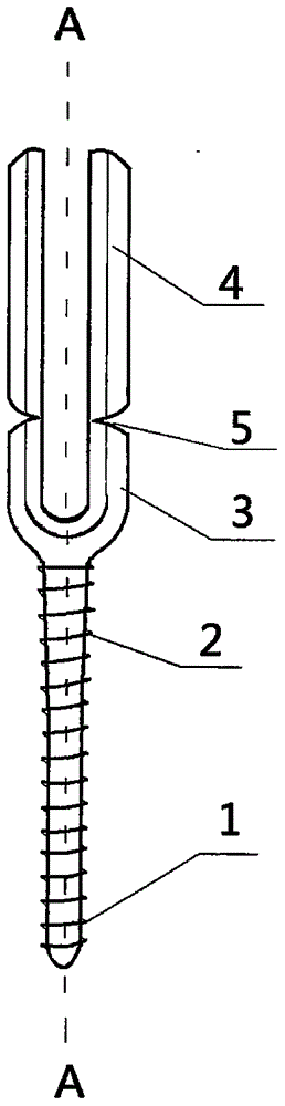 Posterior minimally invasive screw-rod system for thoracolumbar vertebral fracture