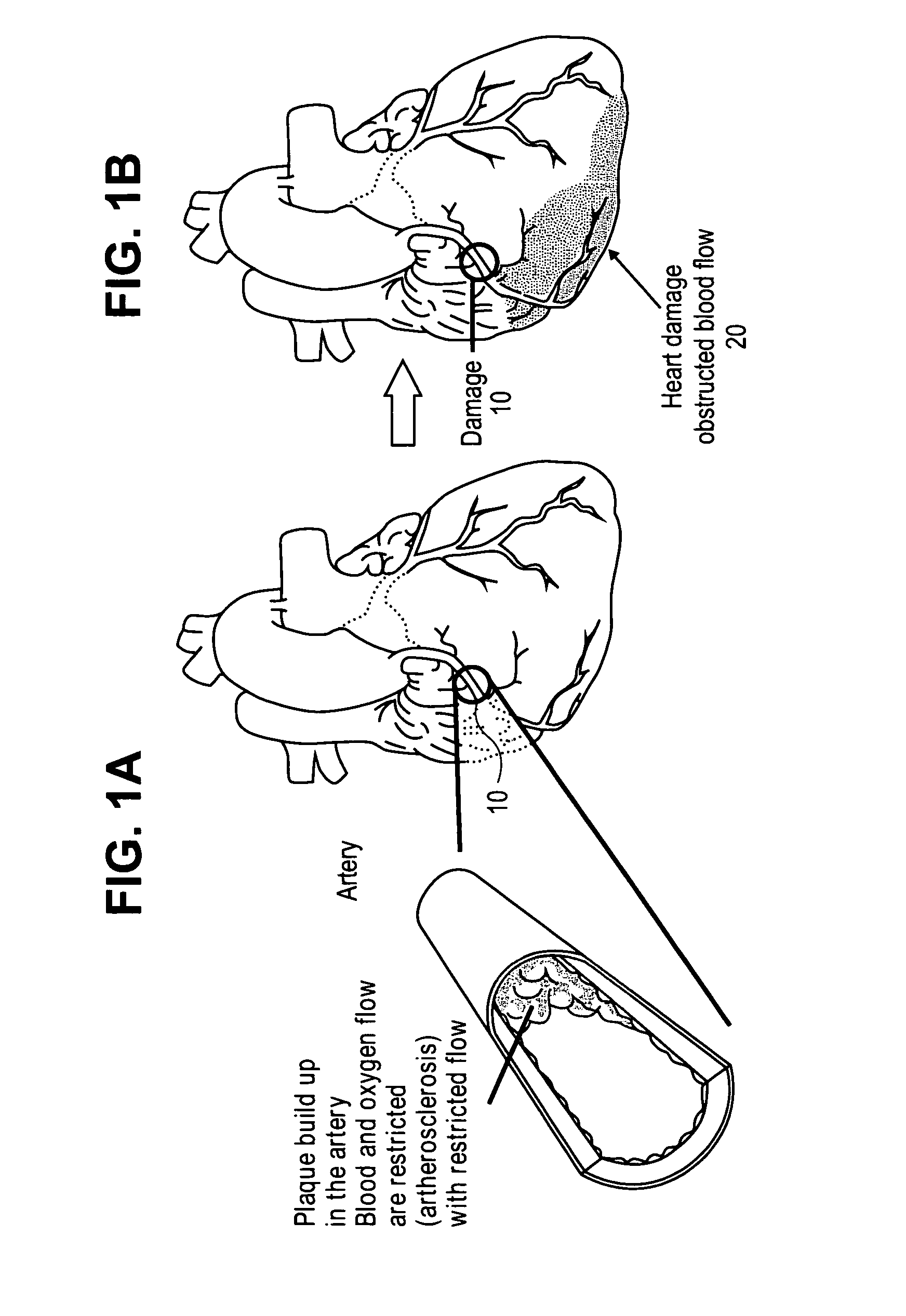 Methods and compositions for treating post- myocardial infarction damage
