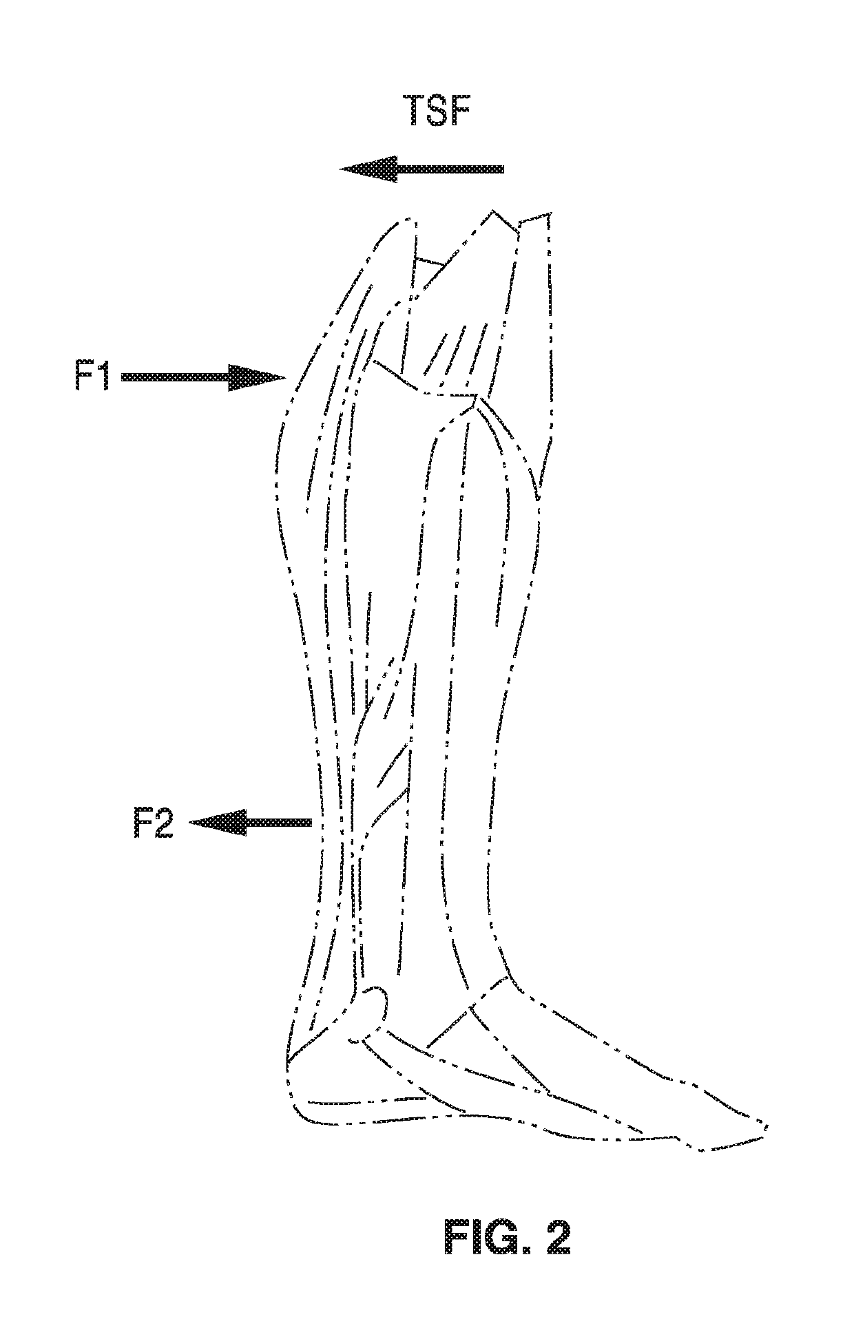 Diagnostic knee arthrometer for detecting ACL structural changes