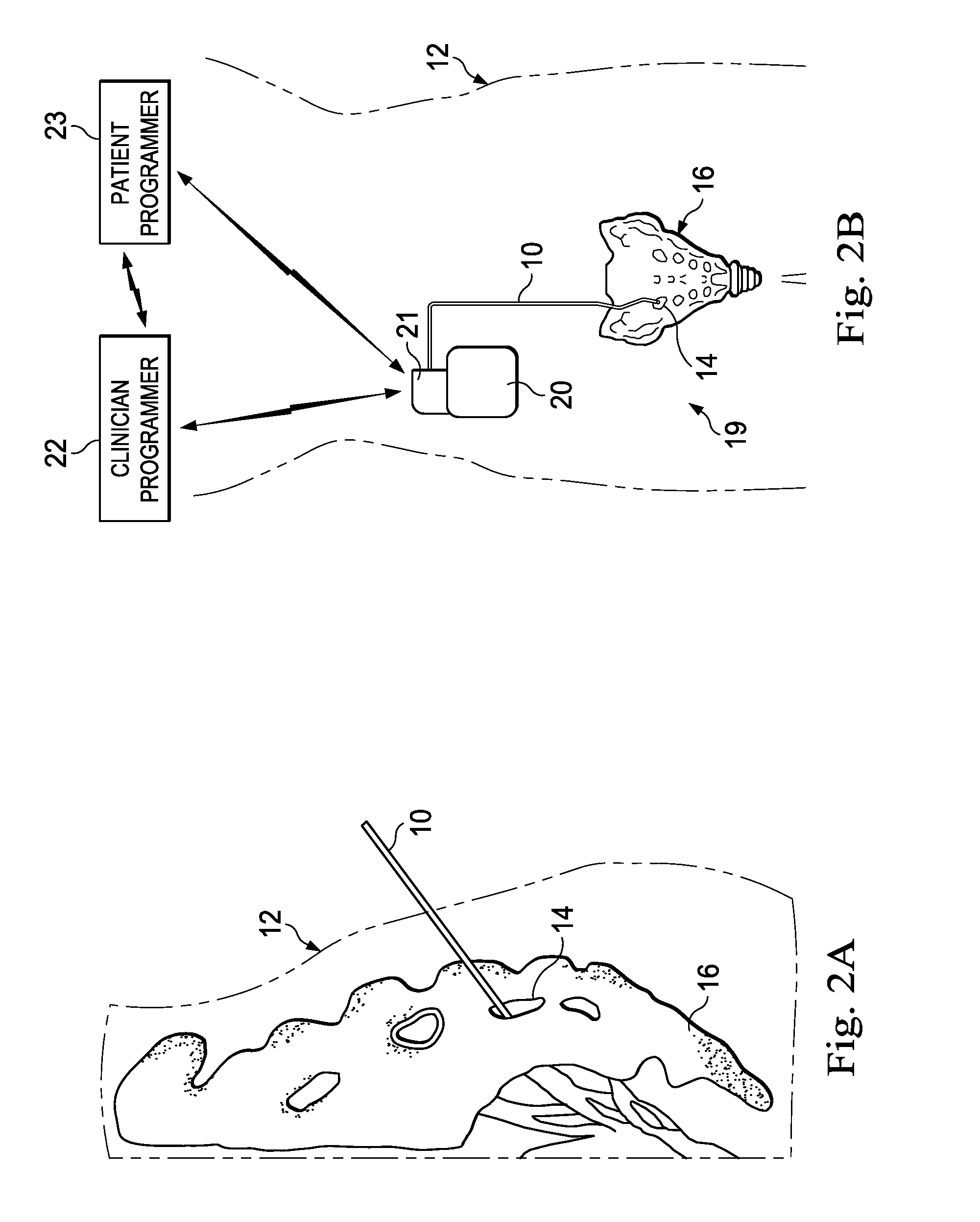 Methods, systems and devices for determining optimal placement for pudendal nerve stimulation lead using patient feedback