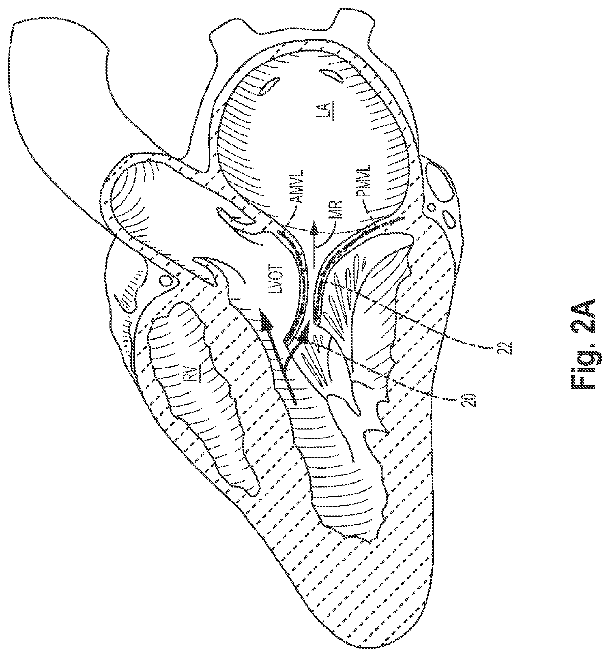 Valve repair devices for repairing a native valve of a patient