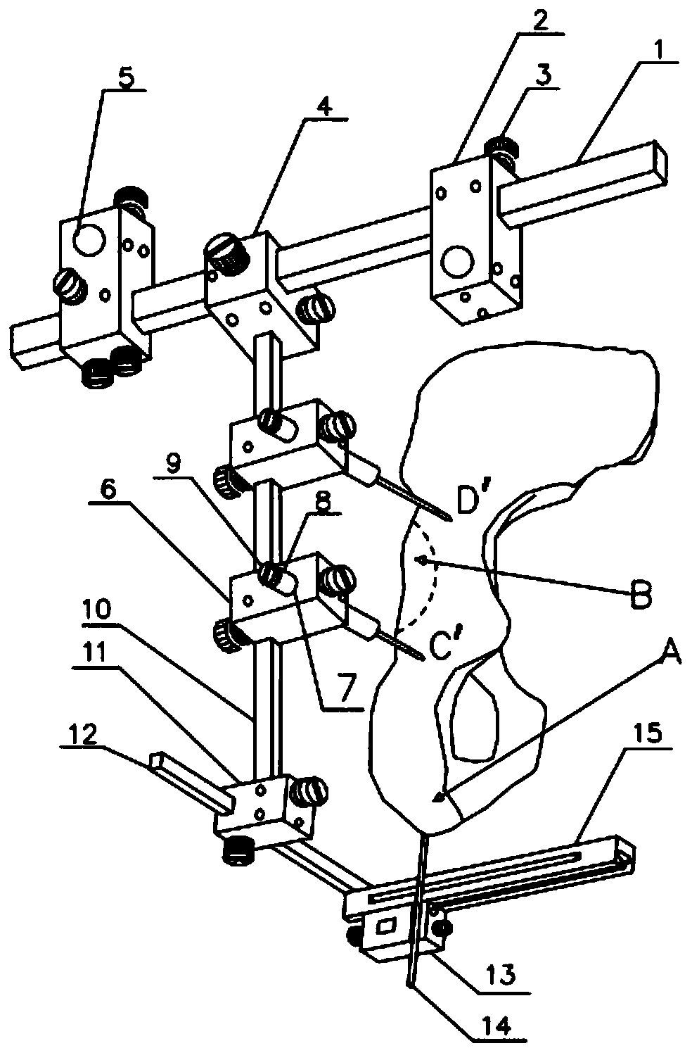 Combined double-node dislocation-minimally invasive retrograde acetabular posterior column screw positioning sight