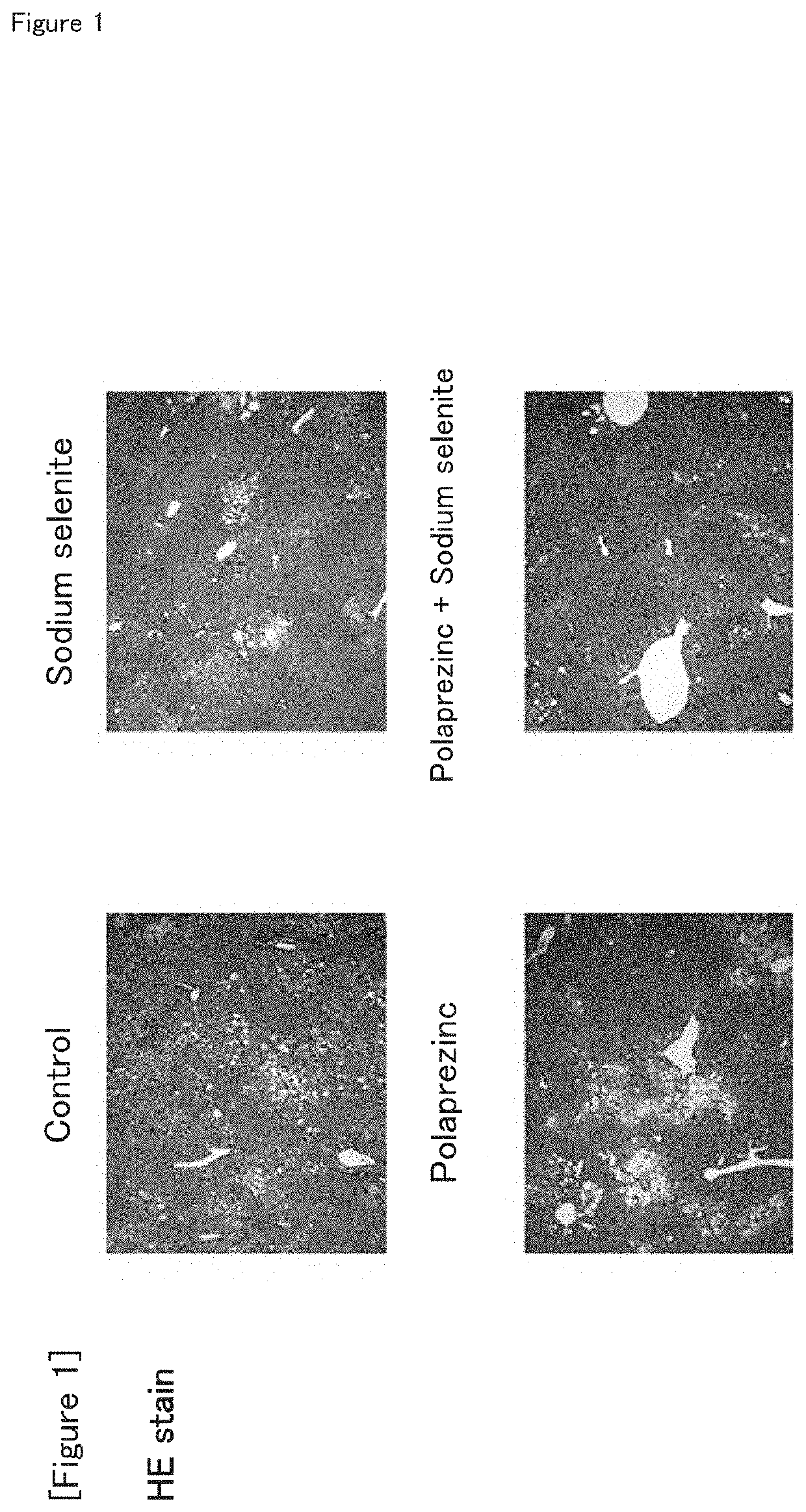 Method for treating non-alcoholic steatohepatitis (NASH) with the combination of polaprezinc and sodium selenite