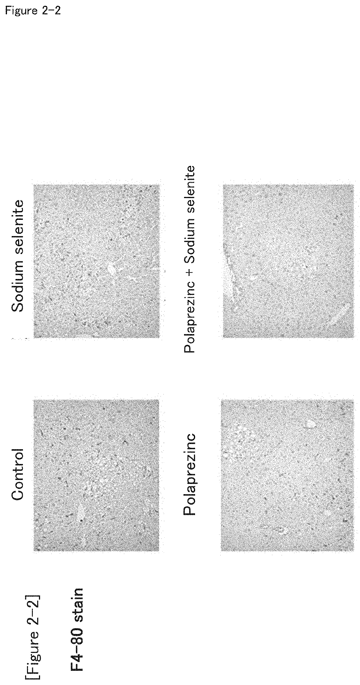 Method for treating non-alcoholic steatohepatitis (NASH) with the combination of polaprezinc and sodium selenite