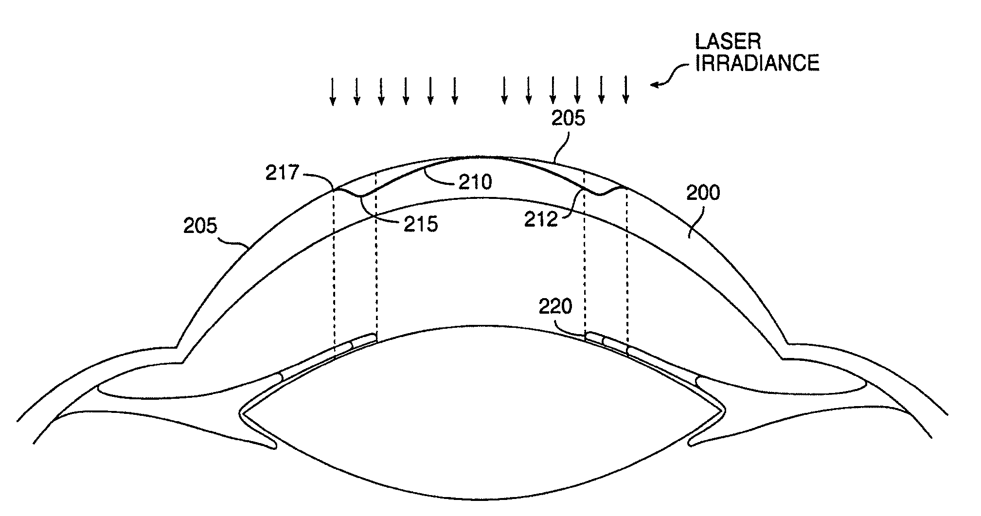 Method and systems for laser treatment of presbyopia using offset imaging