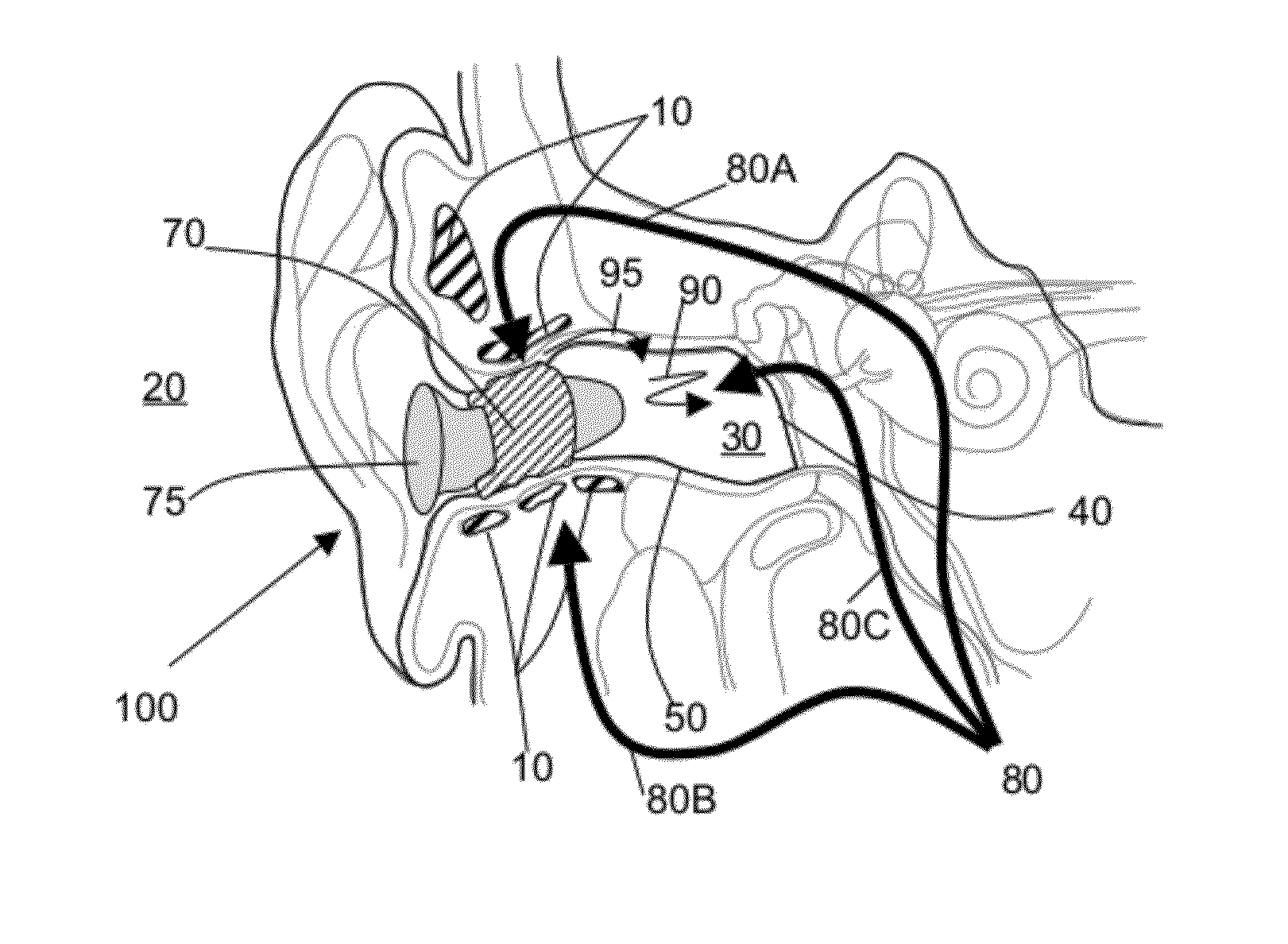 Occlusion effect mitigation and sound isolation device for orifice inserted systems