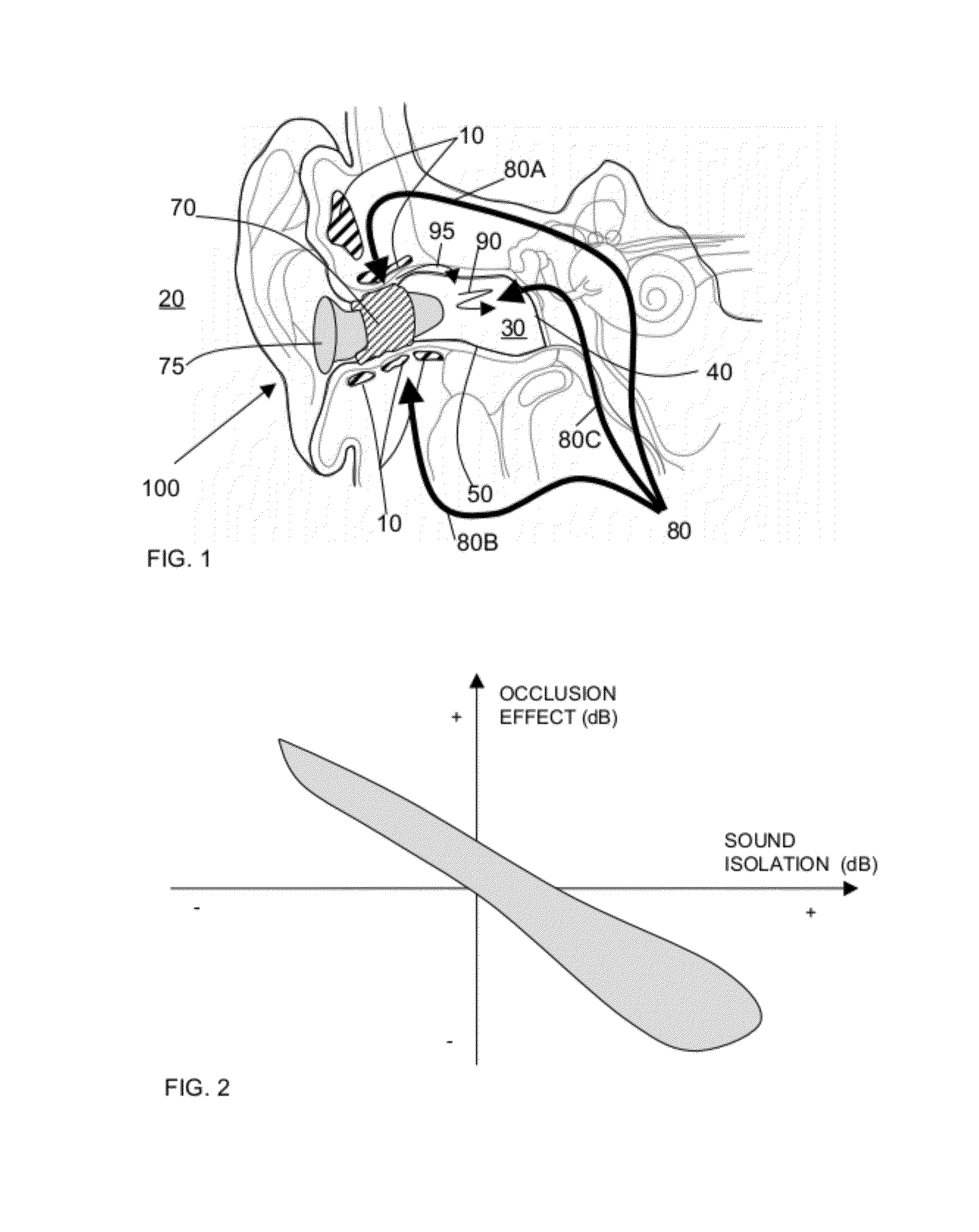 Occlusion effect mitigation and sound isolation device for orifice inserted systems