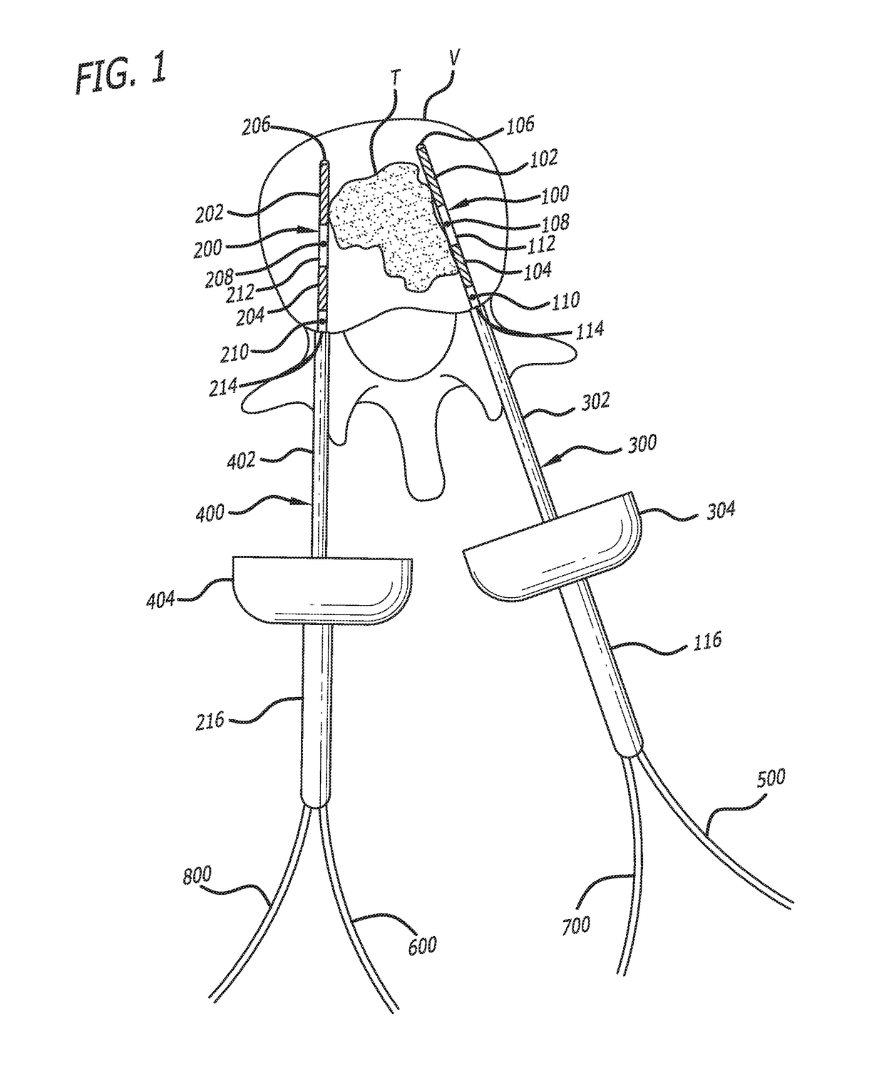 Apparatus for ablation of body tissue and method of use thereof