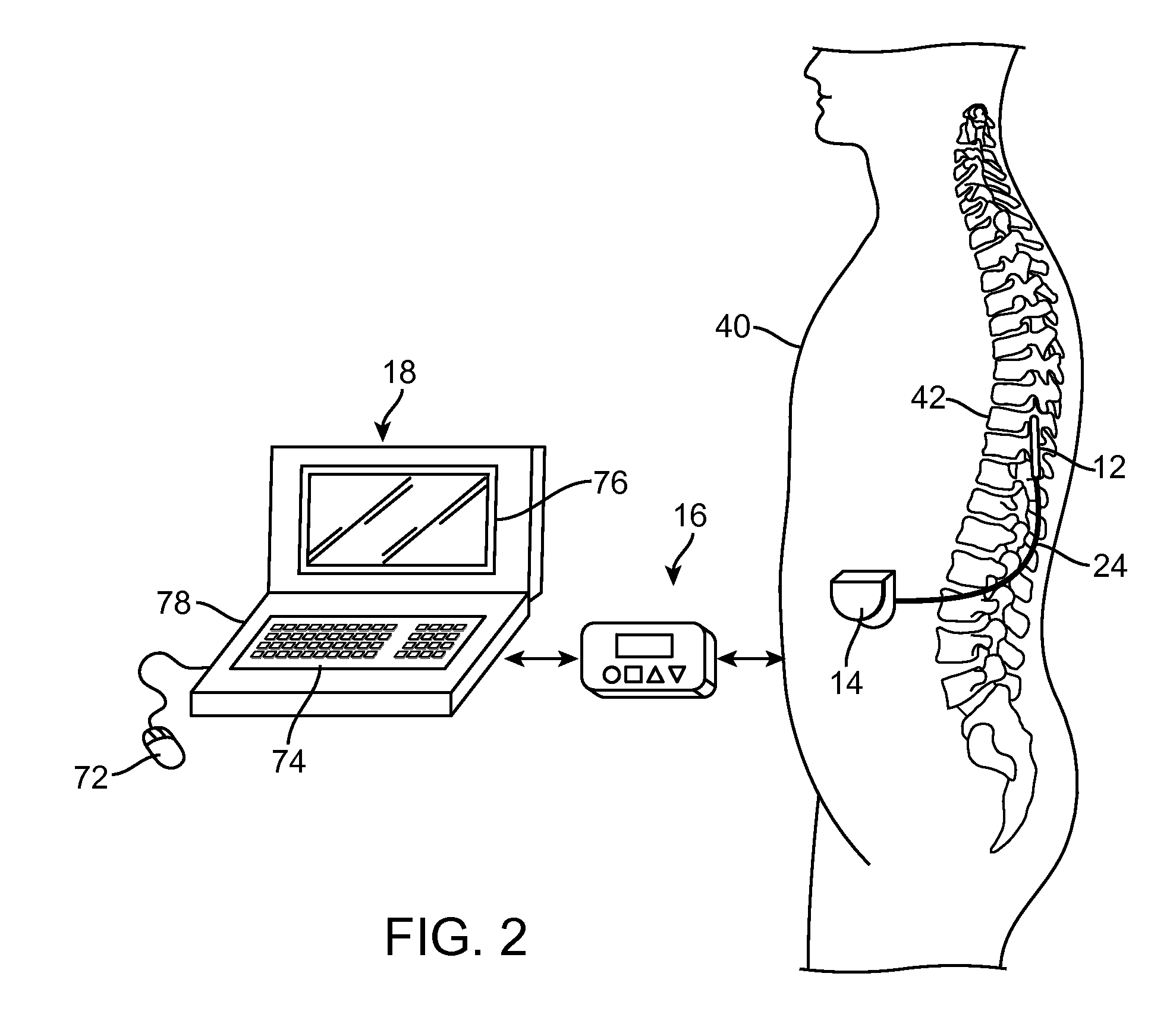 Neurostimulation system for defining ideal multipole configurations at lead boundary