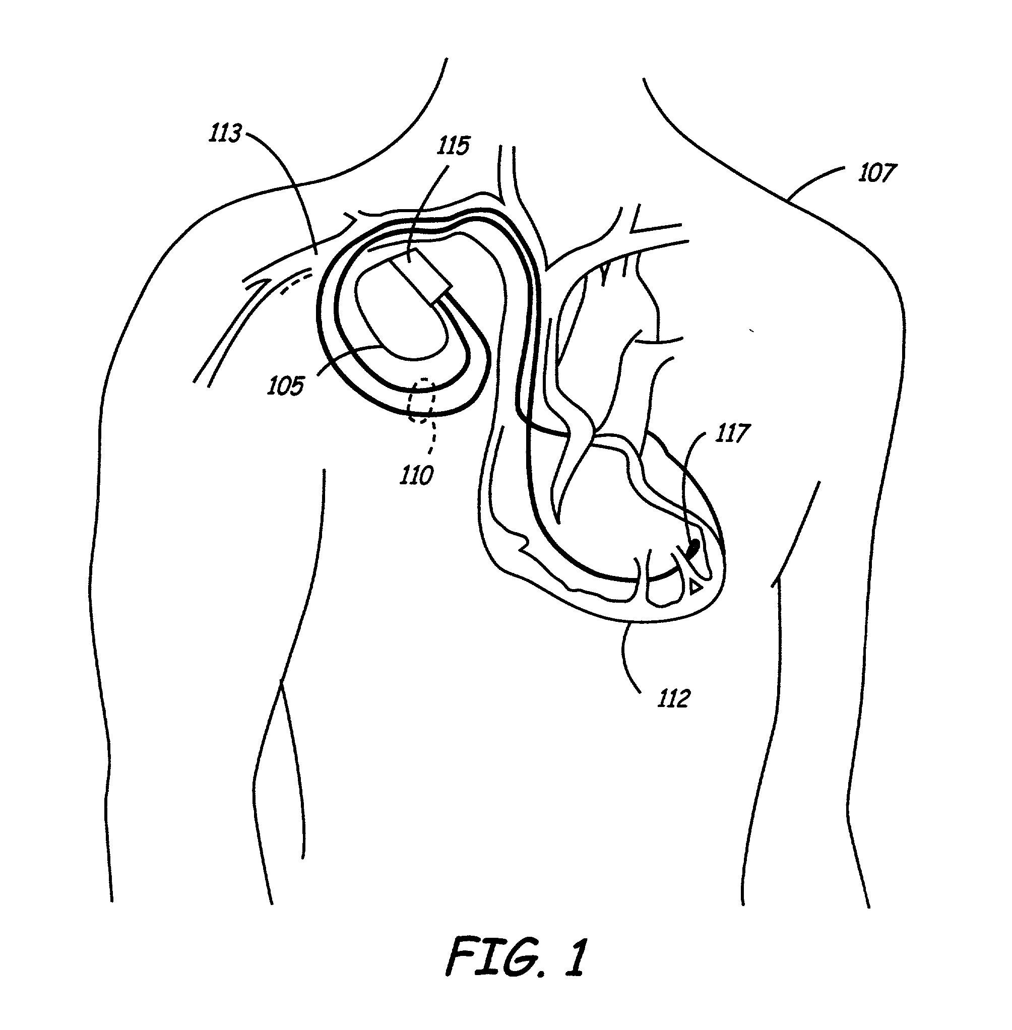Method and apparatus for fixating a pacing lead of an implantable medical device