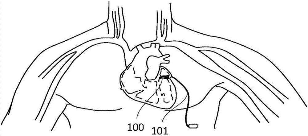 A mitral annuloplasty ring