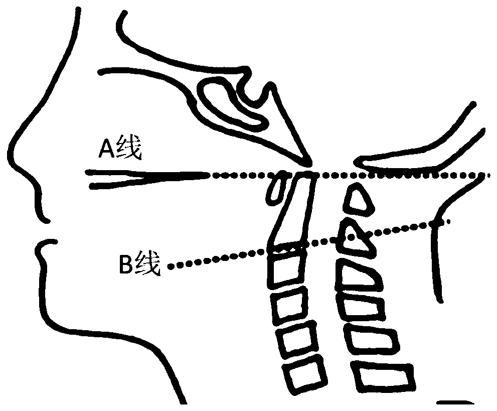 A Posterior Cervical Internal Fixation Apparatus for Reduction of Skull Base Depression