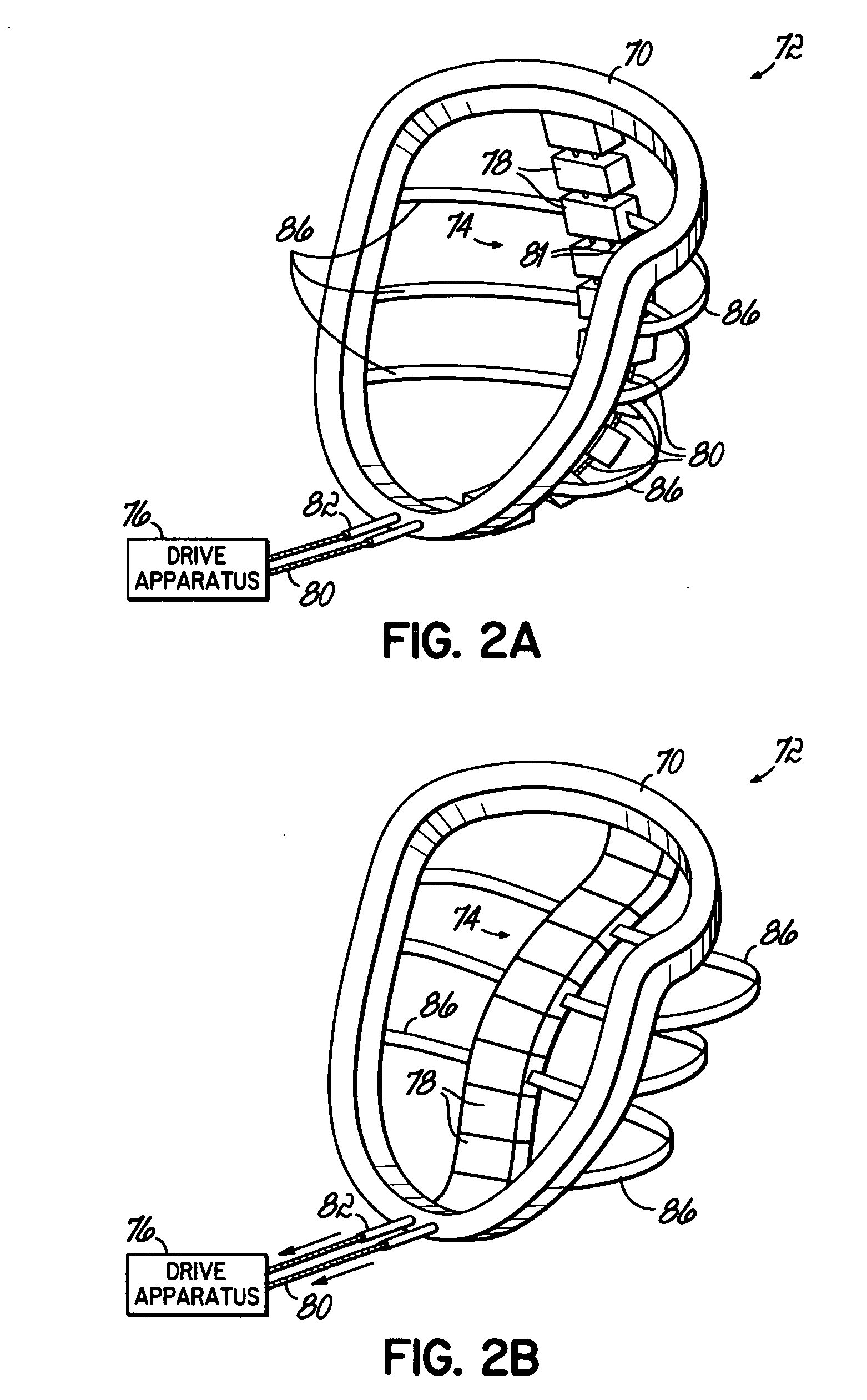 Heart wall actuation system for the natural heart with shape limiting elements