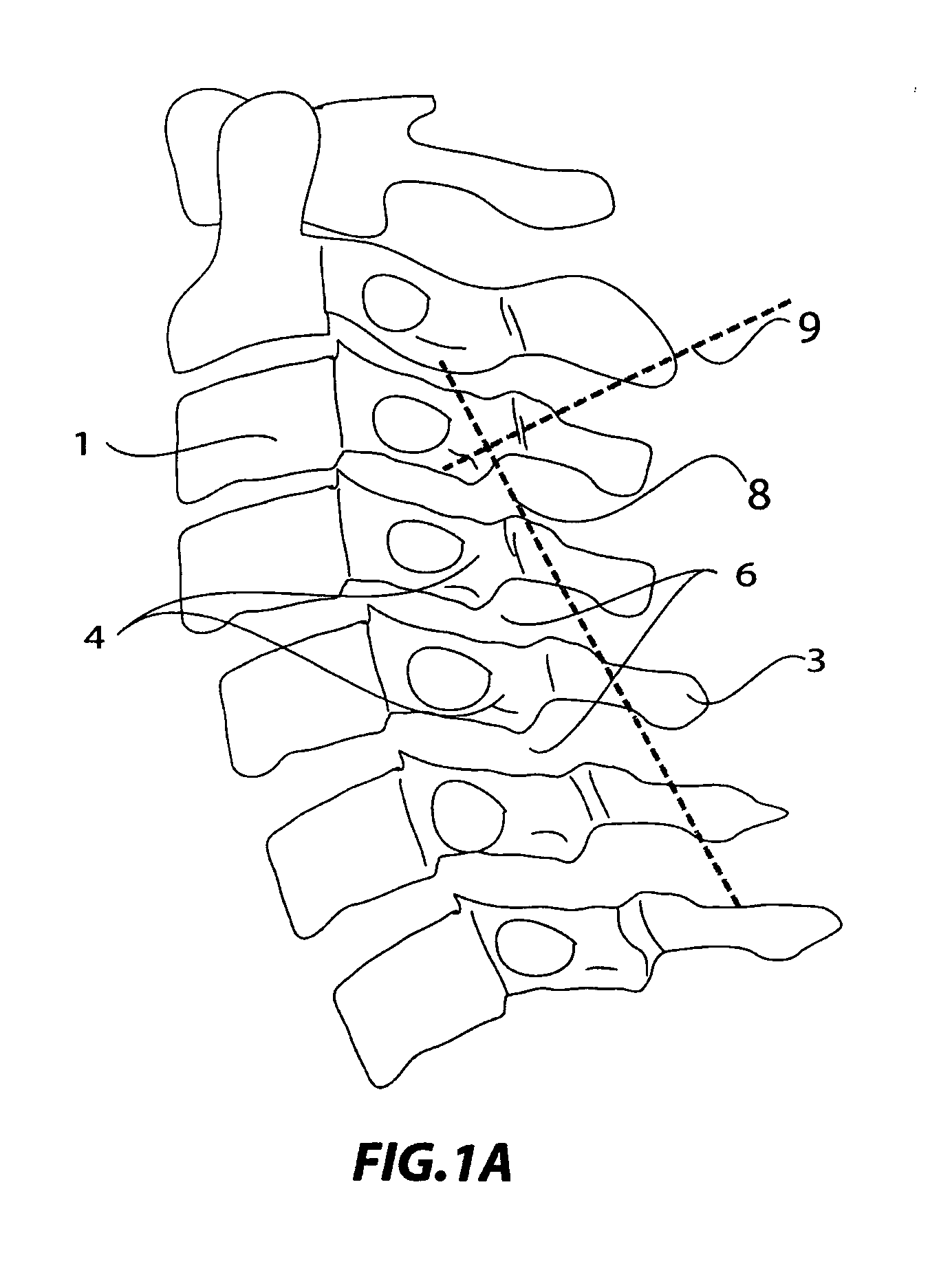 Technique and device for laminar osteotomy and laminoplasty