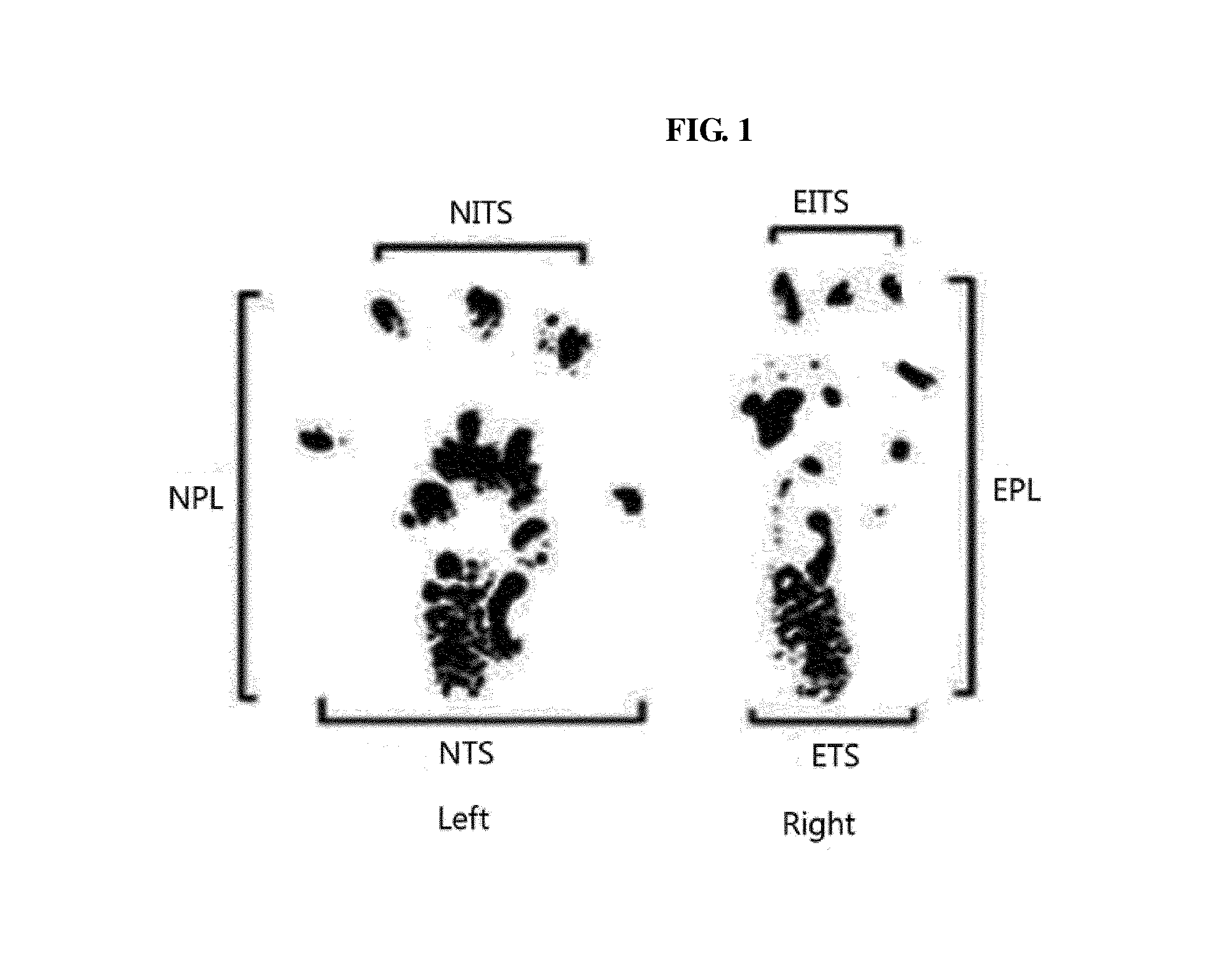 Composition comprising filler and botulinum toxin for alleviating skin wrinkles or aging or treating neuromuscular diseases