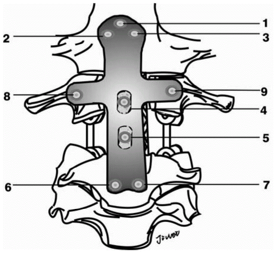 Anterior cervical approach slope fixing device